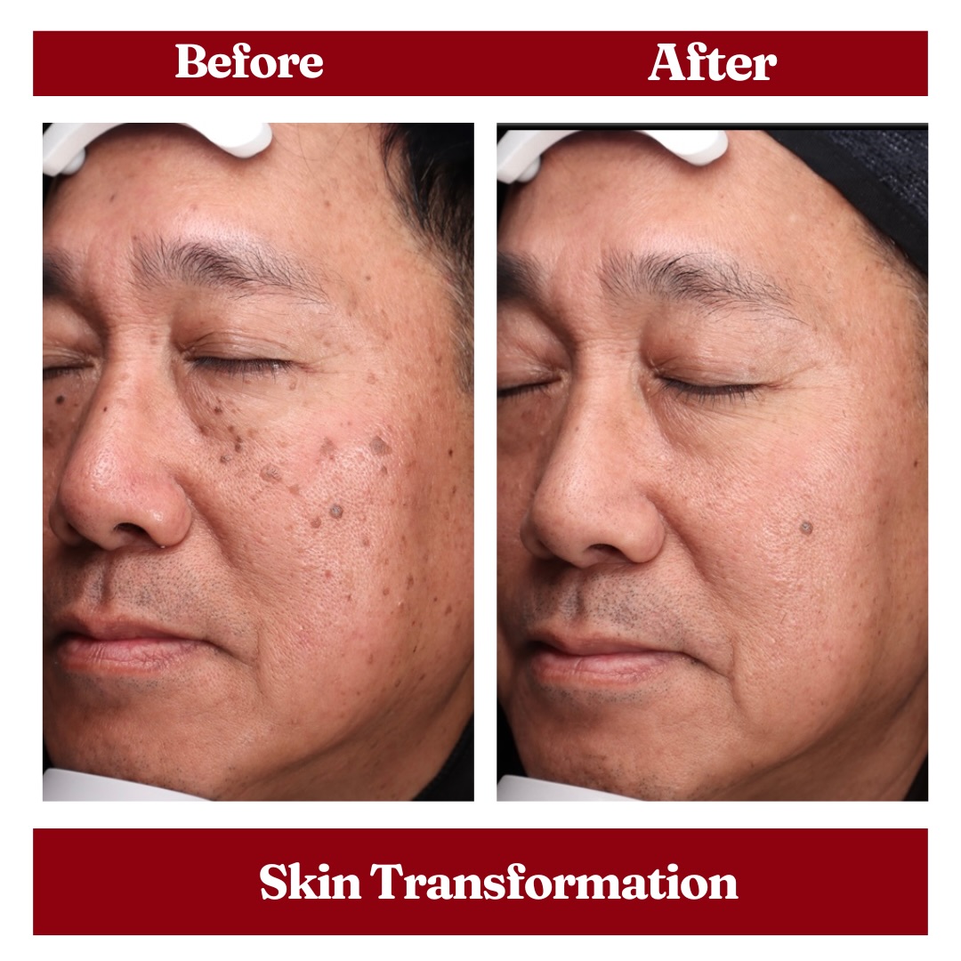 Swipe to see this skin transformation ✨
Brighter, clearer, and more even skin tone achieved through a customized combination of PicoSure and LaseMD Ultra.
PicoSure targets stubborn and deeper dermal pigmentation, while LaseMD Ultra gently resurfaces the skin to improve age spots and pigmented lesions.
When combined, the synergy is powerful, delivering effective results while remaining safe for all skin types and tones.
Ready to transform your skin? Book your consultation today 🤍
📍 4141 Yonge St, Unit 304, Toronto, ON M2P 2A6
📞 (416) 481-2888
📩 booking@redwoodmedispa.com (mailto:booking@redwoodmedispa.com)
#picosure #laseMD #torontomedispa #hyperpigmentation #melasma