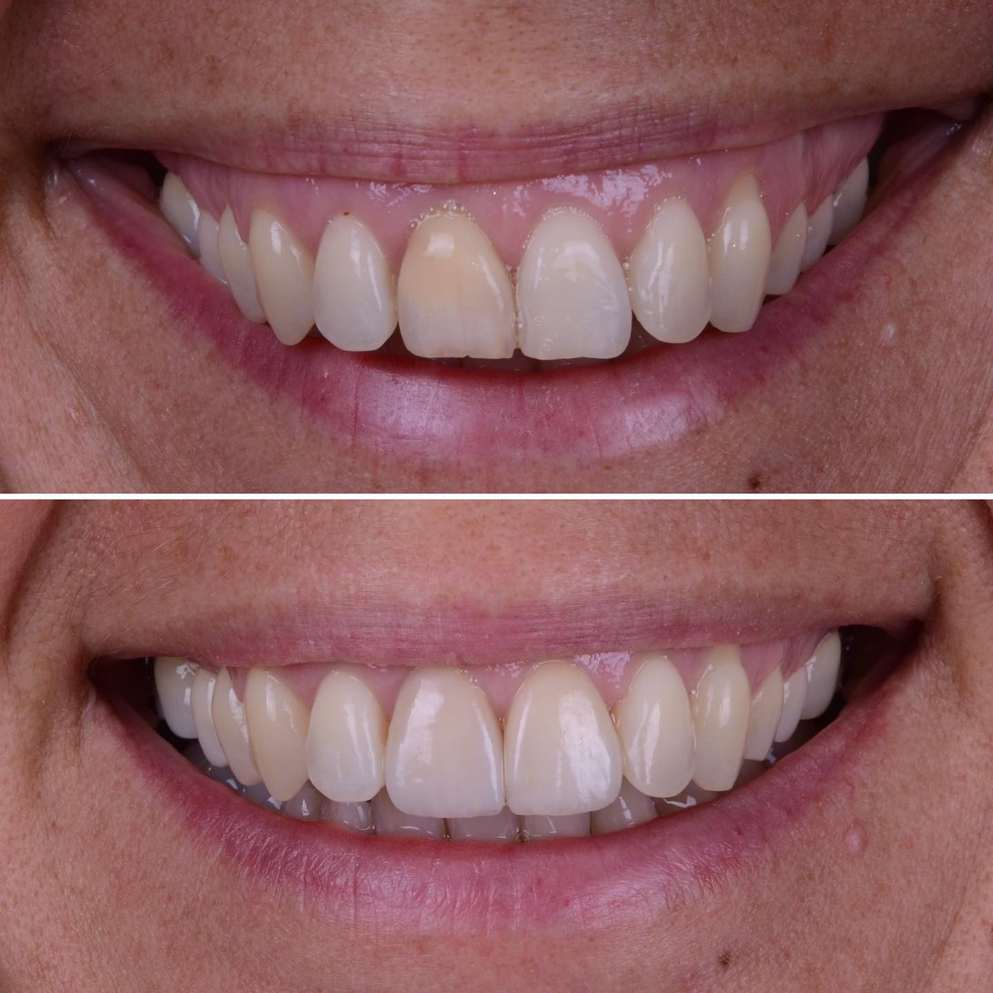 Great example of minimally invasive aesthetic dentistry. The main complaint of the patient was her discolored front tooth. After discussing all treatment options we decided to do two biomimetic ceramic restorations. In order to mask the dark colored tooth we had to create sufficient space for the porcelain in order to mask the darkness and to make sure the tooth will not end up looking bulky - however no crown preparation was necessary. The veneer on the adjacent tooth could be done almost without any preparation. From a smile design perspective creating two similar looking central incisors almost always provides a way better result.
Prior to the esthetic treatment the gums of the patient had to be treated and enough time had to be given for the gums to heal. To achieve these kind of results we all have to be patient 🧘♂️
#Invisalign #gumsurgery #veneers #abudhabidentist #dentistabudhabi #digitalsmiledesign #smiledesign #braces #dubaidentist #dentistdubai #smile #smilemakeover #drmoritz #drbichler #veneers #veneersabudhabi #naturalsmile #biomimeticdentistry #germanmedicine #adent