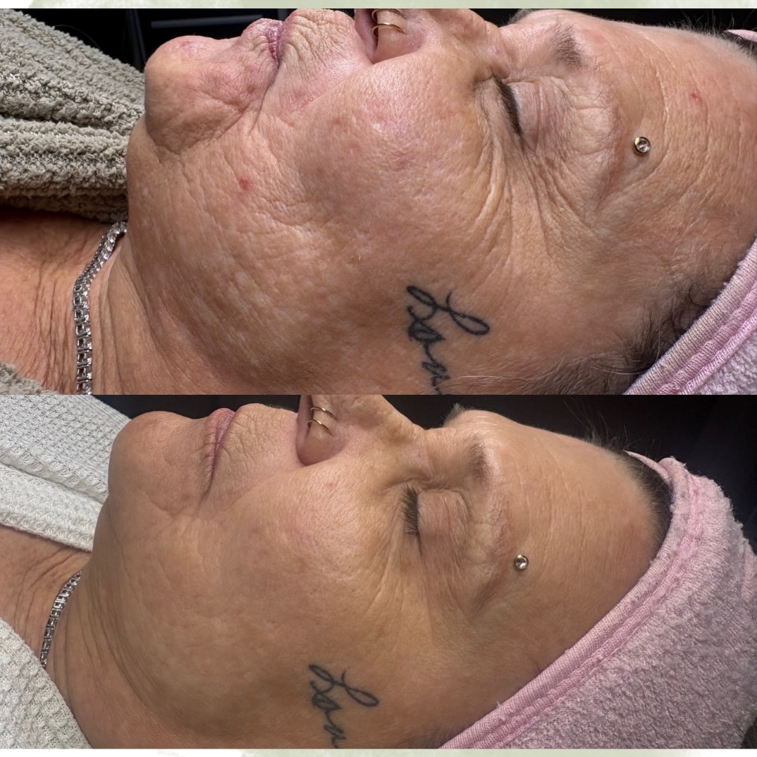 Our Non-Surgical Facelift Combo + Microneedling works beneath the surface to rebuild what time has taken—stimulating collagen, tightening skin, and smoothing texture all in one treatment.
Think:
• Lifted, more defined contours
• Softer lines + wrinkles
• Firmer, tighter skin
• Brighter, smoother complexion
Microneedling boosts it even further by triggering natural skin repair and collagen production—so results keep improving weeks after your treatment.
No downtime. Just skin that looks refreshed, lifted, and naturally you.
The glow isn’t temporary… it’s rebuilding.