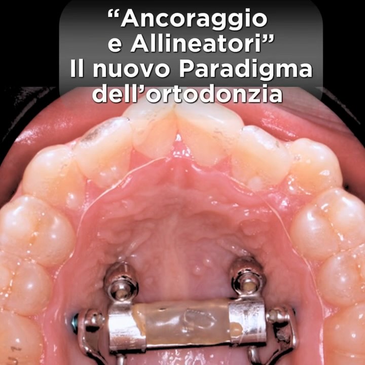 L’ortodonzia sta cambiando rapidamente. E oggi più che mai non basta conoscere una tecnica.
Serve integrare approcci diversi in modo strategico: cosi nasce questo percorso formativo.
È’ strutturato in due giornate distinte, ma strettamente connesse:
👉 La prima dedicata all’ancoraggio scheletrico, per acquisire maggiore controllo, sicurezza e precisione clinica.
👉 La seconda focalizzata sugli allineatori, dalla diagnosi alla pianificazione fino ai trattamenti ibridi.
Due approcci, un unico obiettivo: trattamenti predicibili, performanti e più efficaci.
#ortodonzia #ortodonziaestetica #ortodonziainvisibile #tads #TADS #ancoraggioscheletrico #trattamentoortodontico