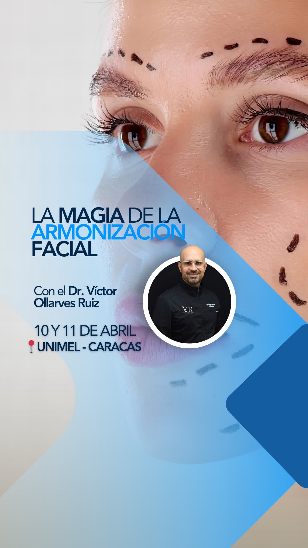 La diferencia entre un resultado improvisado y un resultado verdaderamente armónico casi nunca está en “tener el producto correcto” solamente.
Está en saber analizar el rostro con criterio, entender la anatomía que estás tratando, elegir mejor, intervenir con más precisión y actuar con más seguridad.
Por eso, en La Magia de la Armonización Facial, el enfoque no se queda en la superficie. Es una formación pensada para ayudarte a comprender mejor lo que estás haciendo en consulta, tomar decisiones clínicas más claras y lograr resultados más consistentes, seguros y naturales.
Durante estos dos días trabajaremos análisis facial, anatomía aplicada, selección de productos, planos de aplicación, manejo de complicaciones y ecografía aplicada a rellenos, con práctica en pacientes reales.
👉🏻10 y 11 de abril
👉🏻Unimel, Caracas
Si quieres recibir toda la información, escribe ARMONIZACIÓN en los comentarios y te la envío al DM.
¡Aún tienes oportunidad de inscribirte!