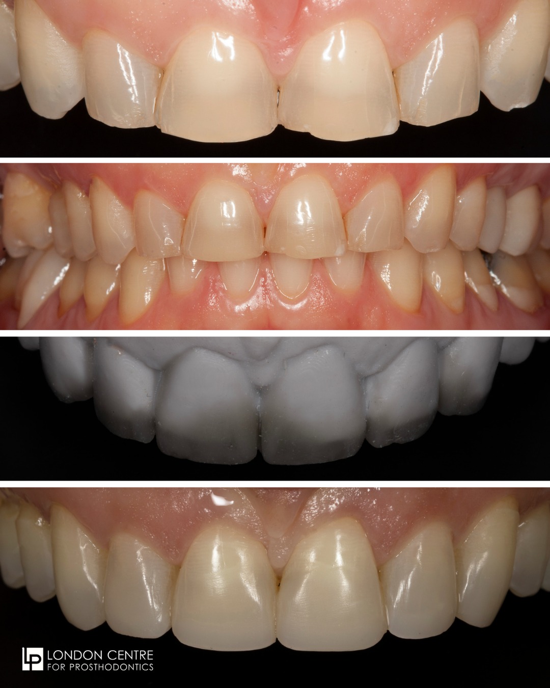We routinely see patients with worn teeth. The wear is most often caused by acid erosion or a tooth grinding habit and sadly results in chipped, worn, and discoloured teeth.
Our aim is always to try and restore the teeth using the most conservative techniques. We believe strongly in using the latest techniques and materials to restore appearance and function and to preserve the teeth. This lovely lady was delighted with the outcome, and she was able to smile confidently once again.
The entire treatment was gentle, painless, and involved adding material to the teeth rather than drilling or removing any natural tooth. If you are worried about worn teeth, do not delay treatment. Protect your teeth and regain your smile by coming to see us.
Get in touch with our team to book your appointment - we look forward to seeing you soon!
The London Centre For Prosthodontics
29 Weymouth Street
London, W1G 7DB
020 7637 4518
info@londonprosthodontics.com
Monday - Friday: 7:30am - 4:30pm
#SmileMakeover #EmergencyDentistLondon #LondonDentalClinic #SmileTransformation #CosmeticDentistLondon
