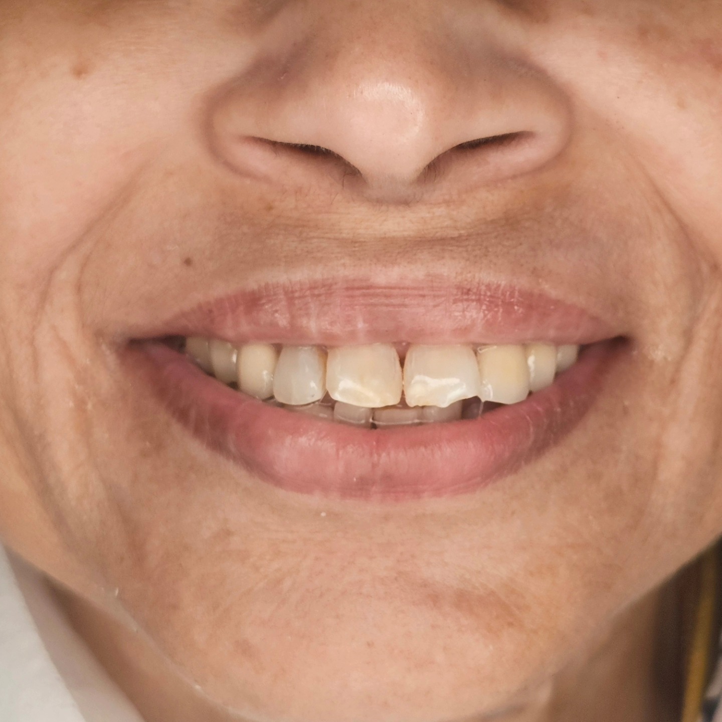 What is the material of the prosthesis delivered?? DISCLAIMER : The crown in 44 is untouched. P. S. You can also comment about different treatment plans .
Begin with the end in mind - A proper plan and a precise execution will deliver quality results.
A not complete but definitely a full mouth rehabilitation of a lovely lady whose quality of life post op will definitely improve considering the pre op situation.
Precise, Pleasant and Aesthetic Dentistry By Dr. Sethuraman Ramadoss MDS Prosthodontist and Implantologist