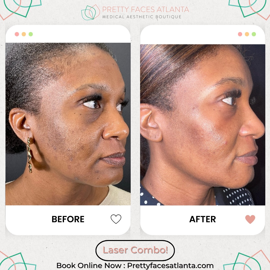 7 reasons why your acne isn’t going away ⬇️
1️⃣ You’re only treating the surface
2️⃣ Acne bacteria is still active under the skin
3️⃣ Inflammation isn’t being reduced
4️⃣ Your pores are still clogged deep down
5️⃣ Dark spots + acne marks aren’t being treated
6️⃣ You’re inconsistent with treatments
7️⃣ You’re not using a treatment that actually targets ALL of it
✨ This is where laser comes in
Aerolase + PicoSure work below the skin to:
• kill acne causing bacteria
• calm redness + inflammation
• shrink pores + reduce oil
• clear dark spots + smooth texture
💥 Laser Packages (best results come in series):
1 for $500
2 for $550
3 for $800
Consistency + the RIGHT treatment = clear skin
📍Book now at PrettyFacesAtlanta.com
#PrettyFacesAtlanta #AtlantaMedSpa #AcneTreatment #LaserFacial #ClearSkin