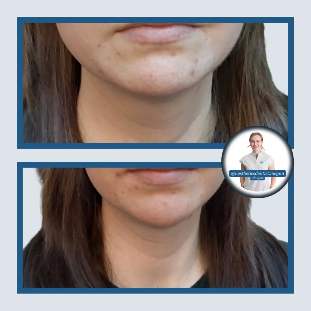 CHIN augmentation, or as I like to call them: the Cherry on the bottom 🍒
A perfectly balanced chin can balance the whole face!
Heart shaped and feminine for this lovely lady
Often we need to plan to treat multiple layers of the face to get the best outcome 👌
Megan x
Dentist led aesthetics in Glasgow
Link in bio or feel free to reach out