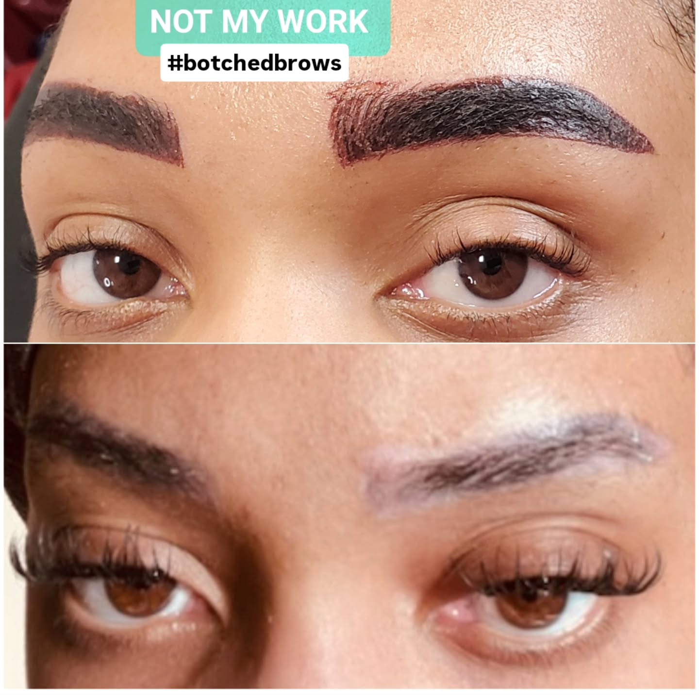 ๐ฌ She reached out to me in a panicโฆ
Her brows were botched, the worng shape, too heavy, and not what she asked for.
This was NOT my work โ but fixing it is what I specialize in.๐ช
โจ This is immediately after just ONE emergency saline removal session.
If your brows were recently done and youโre freaking outโฆ
take a breath. You still have options.
๐ค Timing matters with emergency removal โ the sooner you act, the better the results.
๐ South Florida
๐ฒ Text me
#browcorrection #eyebrowtattooremoval #microbladingremoval #botchedbrows #salineremoval pmucorrection southfloridabrows fortlauderdalebeauty