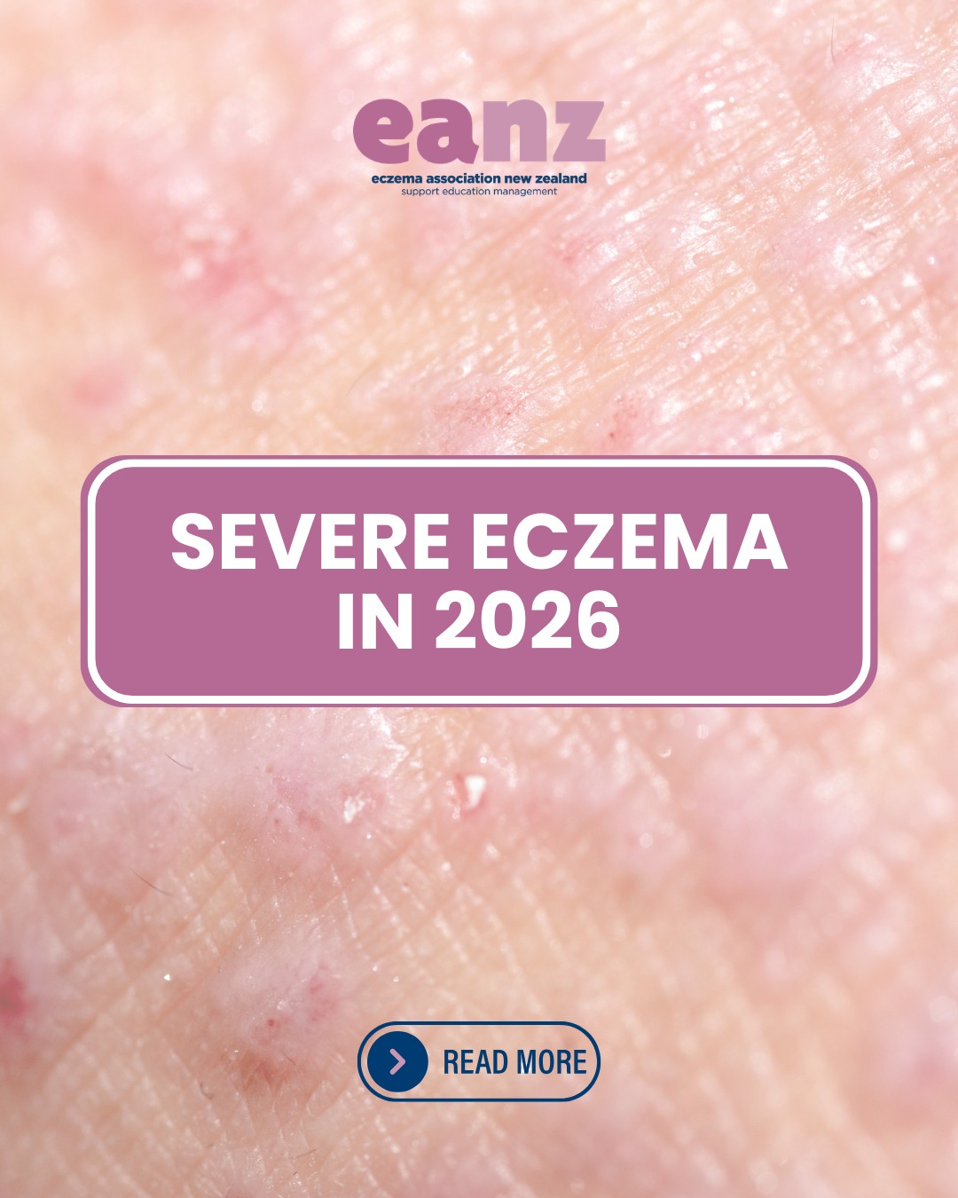 Eczema treatment has evolved
From barrier repair to biologics and JAK inhibitors, severe eczema care in 2026 looks very different
Understanding the pathway = better conversations with your healthcare provider
📌 Save this guide
📌 Share with your community
Read the full article via link in bio
#eczema #eczemasupport #eczematreatment