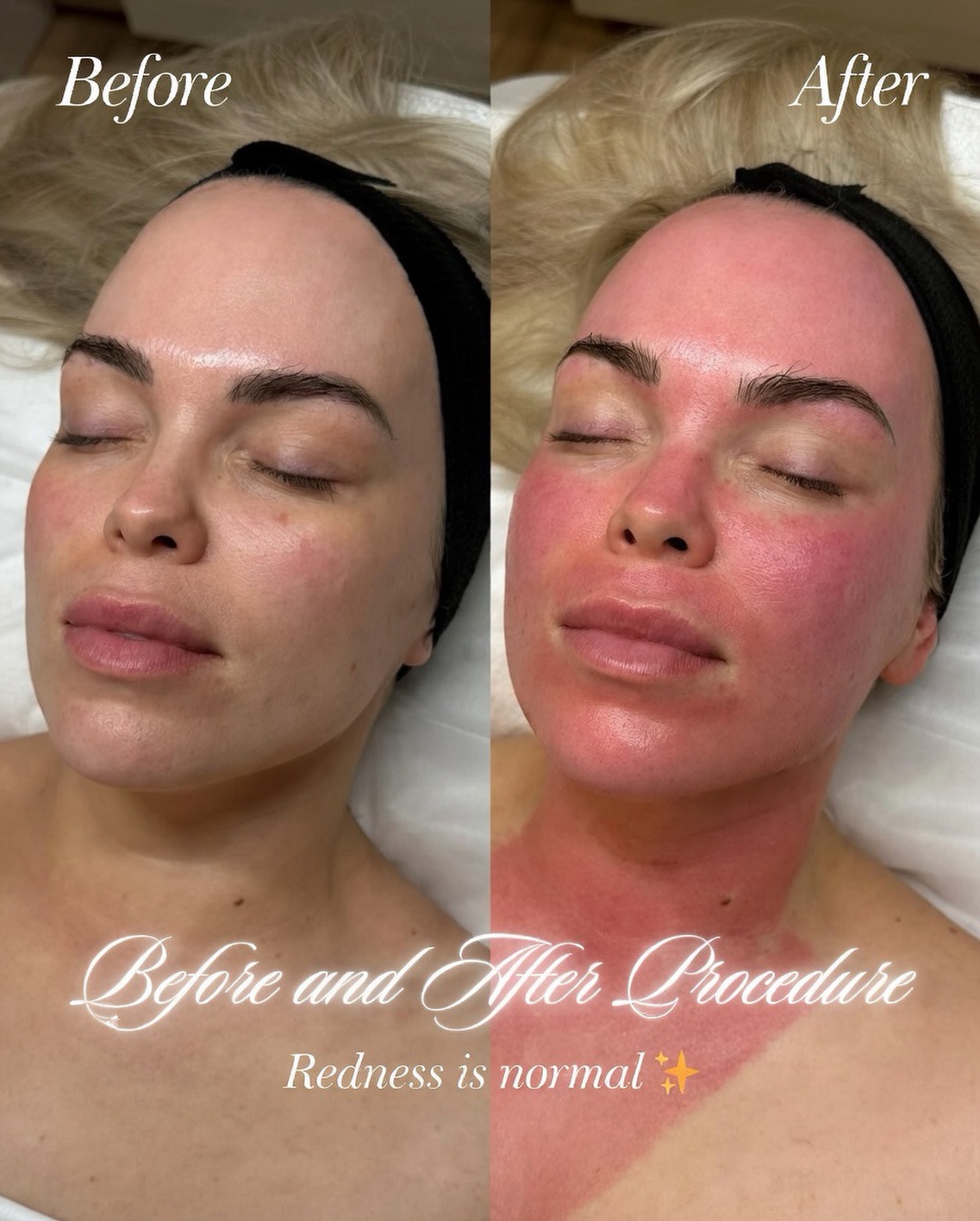 ✨ Microneedling Before & After ✨
This is what your skin looks like right after a microneedling session.
The redness you see is completely normal — it’s your skin’s natural healing response. Tiny micro-channels have been created, triggering collagen and elastin production, which leads to smoother texture, reduced scars, finer lines, and a brighter glow over the coming weeks.
Results continue to improve for up to 4–6 weeks after treatment.
Would you like to experience the power of microneedling?
DM us to book your session in Richmond, London 💌
#Microneedling #BeforeAndAfter #SkinRejuvenation #CollagenBoost #LondonFacials RichmondLondon GlowUp