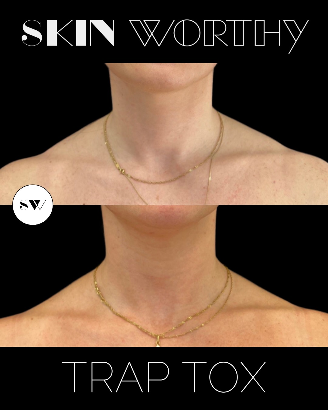 Tank top season is coming… and so are weddings, patios, and events 👀
If you’ve been thinking about Trap Tox, this is your sign to start now.
Not only does it help relieve built-up neck and shoulder tension, it also creates that longer, slimmer neckline and more contoured shoulders—just in time for all the outfits that show a little more skin.
Because results take a couple weeks to fully kick in, now is the perfect window to get ahead of it ✨
For more information you can head to our website for more on traptox or about Nurse Barbs experience with the treatment!