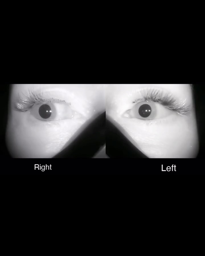 Do you get vertigo when rolling in bed or looking up?
One of the most common causes is BPPV (Benign Paroxysmal Positional Vertigo).
BPPV occurs when small calcium crystals move into one of the semicircular canals of the inner ear. When your head changes position, these crystals move and create abnormal fluid flow, producing vertigo and specific eye movements called nystagmus.
Because the vestibular system is closely linked to eye movements, clinicians can often determine which canal is affected by analysing the pattern of eye movements during positional testing.
This is why it is essential that vestibular clinicians use infrared video goggles. These goggles remove visual fixation and allow subtle eye movements to be detected and recorded, improving diagnostic accuracy.
The good news?
Once the correct canal is identified, BPPV is usually very treatable with repositioning manoeuvres.