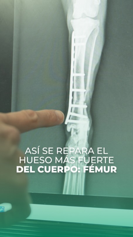 El fémur es el hueso más fuerte del cuerpo, pero cuando se fractura requiere tratamiento especializado.
En este caso, el Dr. Barriga realiza un procedimiento para estabilizar una fractura de la diáfisis del fémur con otras complicaciones de dispositivos protésicos, devolviendo estabilidad y soporte al hueso.
Precisión, experiencia y trabajo en equipo para ayudarte a recuperar tu movilidad. 💪
Agenda tu cita en línea: https://www.clinicatoa.com/
☎️ 02 247 3002 | 📞 098 454 5467
#ClínicaTOA #SaludIntegral #Emergencias24h #AtenciónMédica