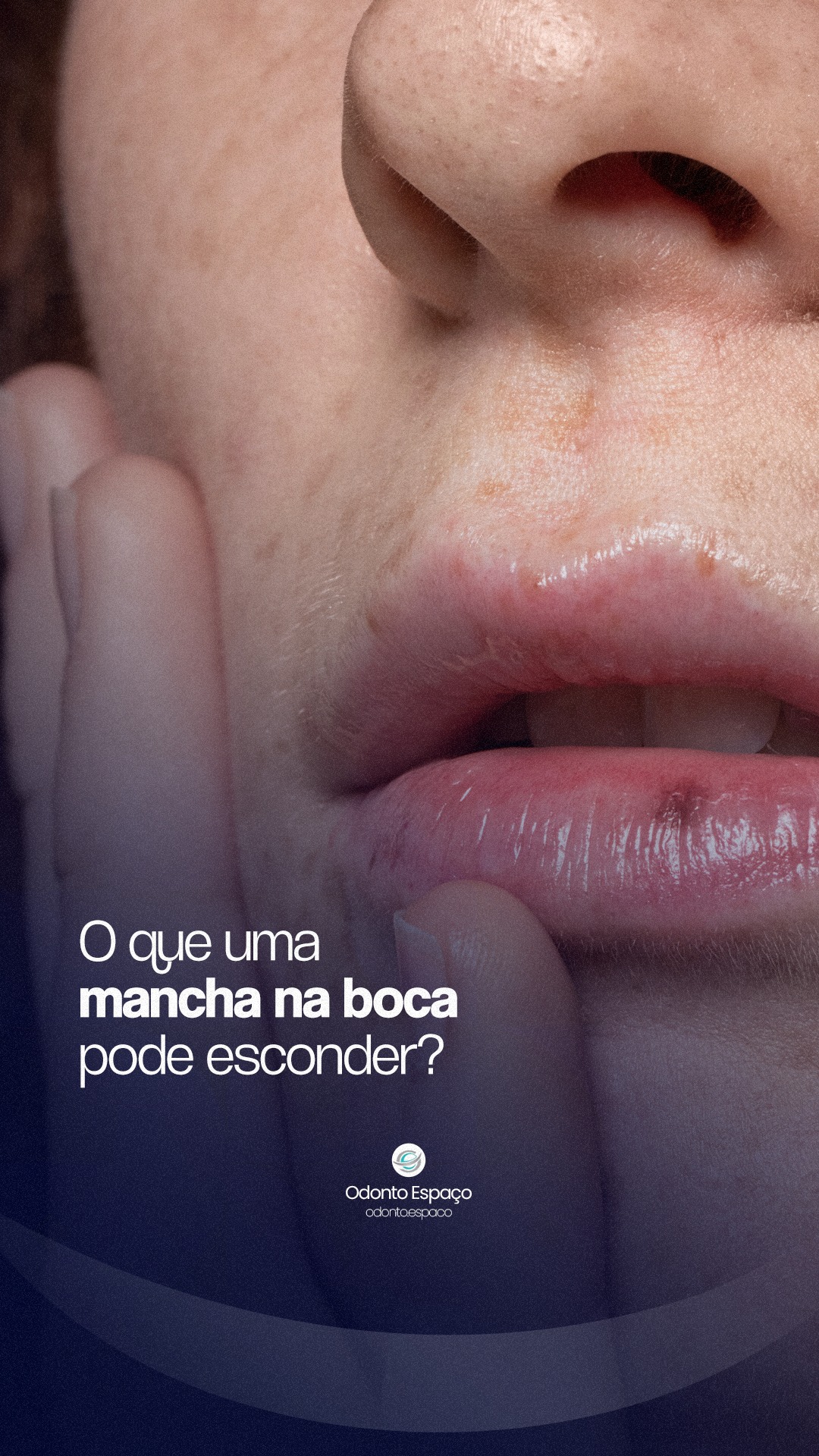 Uma mancha na boca pode ser um sinal de alerta. 🔍🛑
Manchas, feridas que não cicatrizam ou nódulos na boca não devem ser ignorados. A prevenção é a nossa melhor ferramenta de saúde e o diagnóstico precoce faz toda a diferença.
Aqui na OdontoEspaço, contamos com o suporte da Estomatologia para cuidar de qualquer alteração na sua mucosa bucal com precisão e segurança.
Sua saúde começa pela boca. Venha conversar com nossos especialistas. 📩
#odontoespaço #dentistavilamariana #vilamarianasp #VilaMariana #ortodontia #ortodentista #dentistasp
