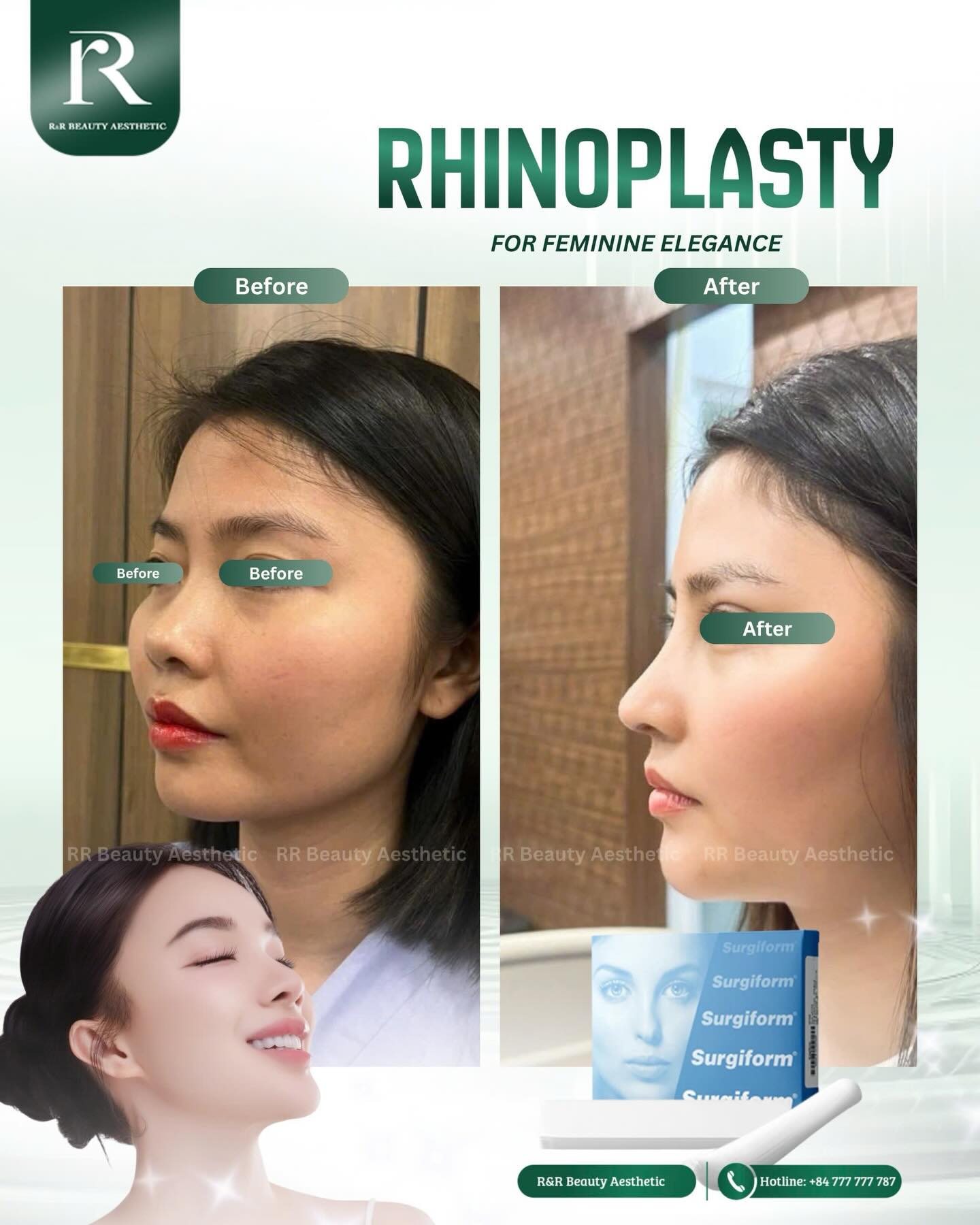 ✨ The profile looks softer and more aligned
✨ Facial features appear more balanced
✨ The nose blends naturally into your overall look
✨ Expressions feel lighter and more confident
🔥 Send us a message to start your consultation
Private appointments available
.
.
#rhinoplasty #subtlebeauty #facialbalance #naturalresults #aestheticjourney