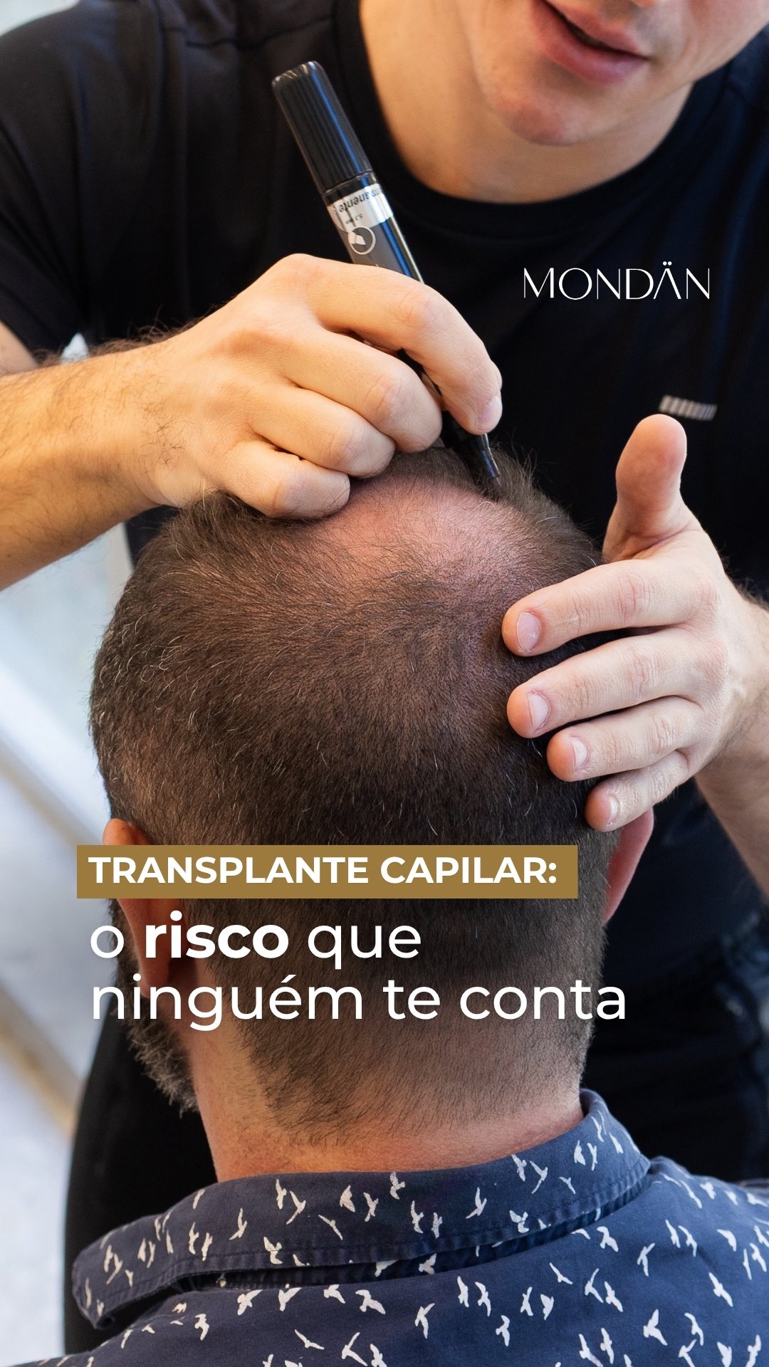 O transplante capilar vai muito além da estética.
Para muitos pacientes, ele marca um ponto de virada: mais confiança, mais cuidado consigo mesmo e uma nova relação com o espelho.
Mas é importante lembrar: trata-se de um procedimento cirúrgico, que exige avaliação criteriosa, técnica e acompanhamento adequado.
Na Mondän, o transplante capilar é conduzido com análise criteriosa, planejamento detalhado e acompanhamento próximo em todas as etapas do processo.
Se você busca segurança, naturalidade e densidade real, agende sua avaliação. Será um prazer cuidar de você nesse processo.