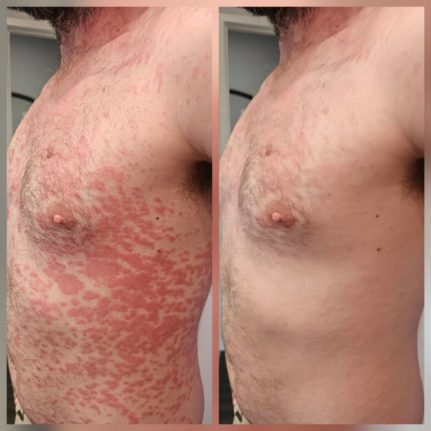 Treating Psoriasis
Using THE MASK and customized skincare
@thepowderroom_by_ginene