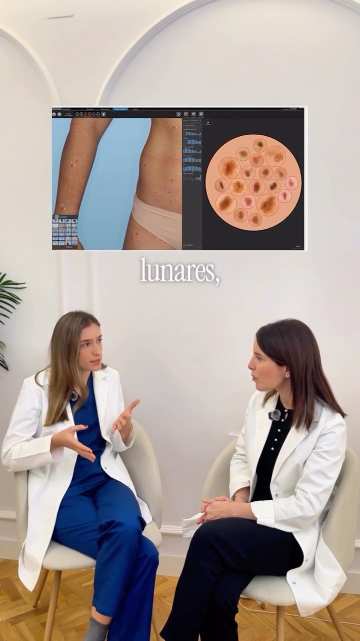 La Dra @mireiasegui responsable de la Unidad de Monitorización Cutánea Digital de Esthea Médica, nos explica su visión de la revisión avanzada de la piel se trata de realizar la unión perfecta entre tecnología de alta precisión y criterio clínico. Su experiencia en dermatoscopia, también desarrollada en la Fundación Jiménez Díaz, refuerza una forma de trabajo basada en la observación minuciosa de imágenes y el seguimiento experto de cada lesión para ver “allí donde el ojo no ve”
Muchos pacientes nos preguntan qué diferencia una revisión avanzada de una convencional. La dra @mireiasegui nos cuenta cómo la dermatoscopia digital hace visible lo invisible. “Las imágenes de alta resolución microscópicas se graban y podemos comparar la evolución de las lesiones; esto nos da un arma poderosa porque nos adelantaremos a cualquier lesión maligna para quitarla antes de que sea tarde”. Nos dice la Dra.
Imagen de alta resolución
Documentamos la piel con un nivel de definición que permite una valoración clínica especialmente precisa, asistida por IA. La IA no sustituye al ojo experto pero sí facilita el cribado.
Superposición y comparación evolutiva de imágenes
La superposición digital de estudios sucesivos es esencial para detectar nuevas lesiones y para identificar cambios sutiles en lesiones ya existentes. La IA permite identificar nuevas lesiones y cambios microscópicos que hace solo 3-4 años no era posible.
Análisis experto y personalizado.
Cada estudio se realiza bajo supervisión médica directa, con el tiempo y el criterio que una valoración rigurosa requiere.