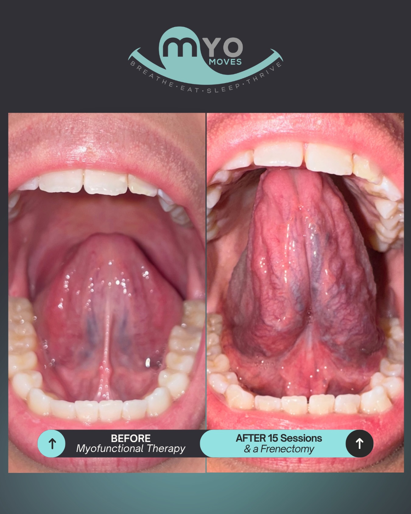One of the things people ask us most: “Will therapy actually make a difference?”
This is what consistent myofunctional therapy pre and post tongue tie release can do.
Left: Limited tongue elevation, reduced control
Right: Improved lift, strength, and functional movement after myofunctional therapy and a frenectomy done by Dr. Sweeney.
When the tongue can elevate and stay engaged against the palate, the entire system works better—breathing becomes easier, swallowing more efficient, and oral rest posture naturally improves.
This isn’t just about how it looks. It’s about how it functions every single day.
This transformation took dedication, consistency, and targeted exercises that address the root cause—not just the symptoms.
If you’ve been wondering whether myofunctional therapy can create real change for you or your child, this is your answer.
Ready to explore what’s possible? Comment GUIDANCE and we’ll help you take the next step.
#tonguetie #myofunctionaltherapy #myo #airwayhealth #breathebetter