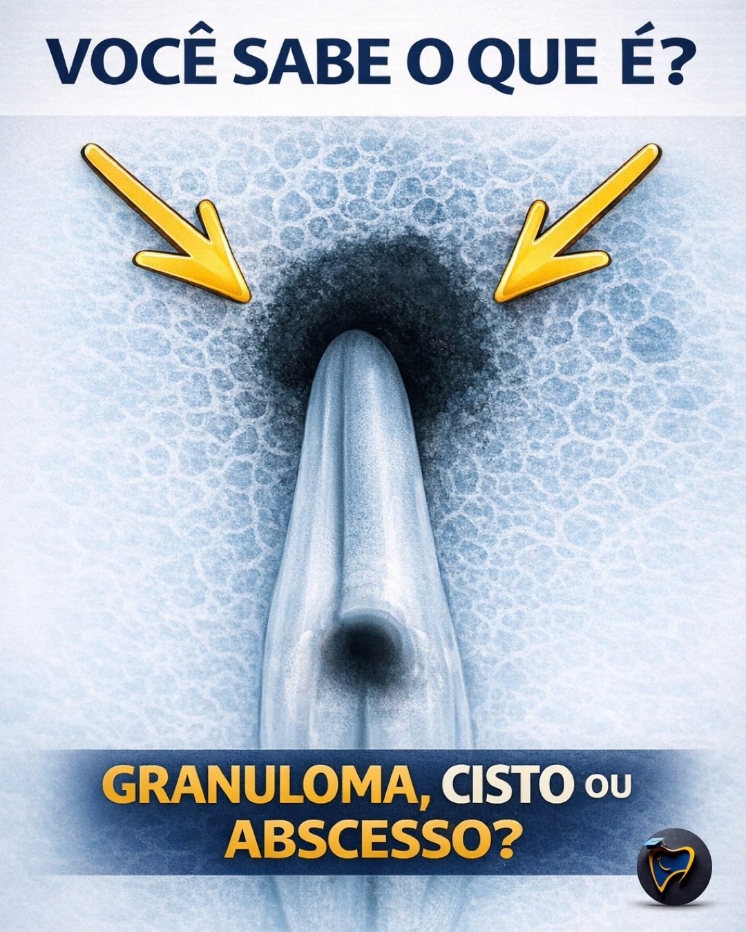 Na Endodontia, maturidade clínica não é parecer seguro.
É saber o que a radiografia mostra, o que ela não mostra e como agir apesar disso.
Se você gosta de conteúdo que aprofunda o raciocínio clínico sem simplificações infantis, este perfil é para você.
Siga @endotoday para acompanhar conteúdos avançados de Endodontia.
E acompanhe também o blog da EndoToday para ler análises mais profundas, discussões clínicas e conteúdo baseado em evidências.
Salve este post para revisar depois.
Envie para um colega que ainda confunde imagem radiográfica com diagnóstico histológico.
#endodontia
#endodontista
#odontologia
#canalradicular
#casoclinico