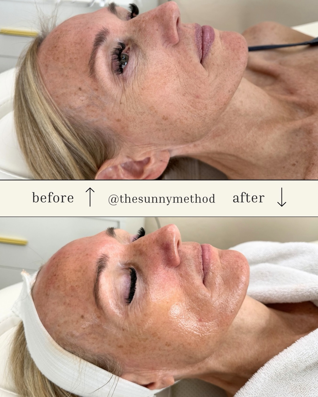 Dermaplane facial with focus on hydration