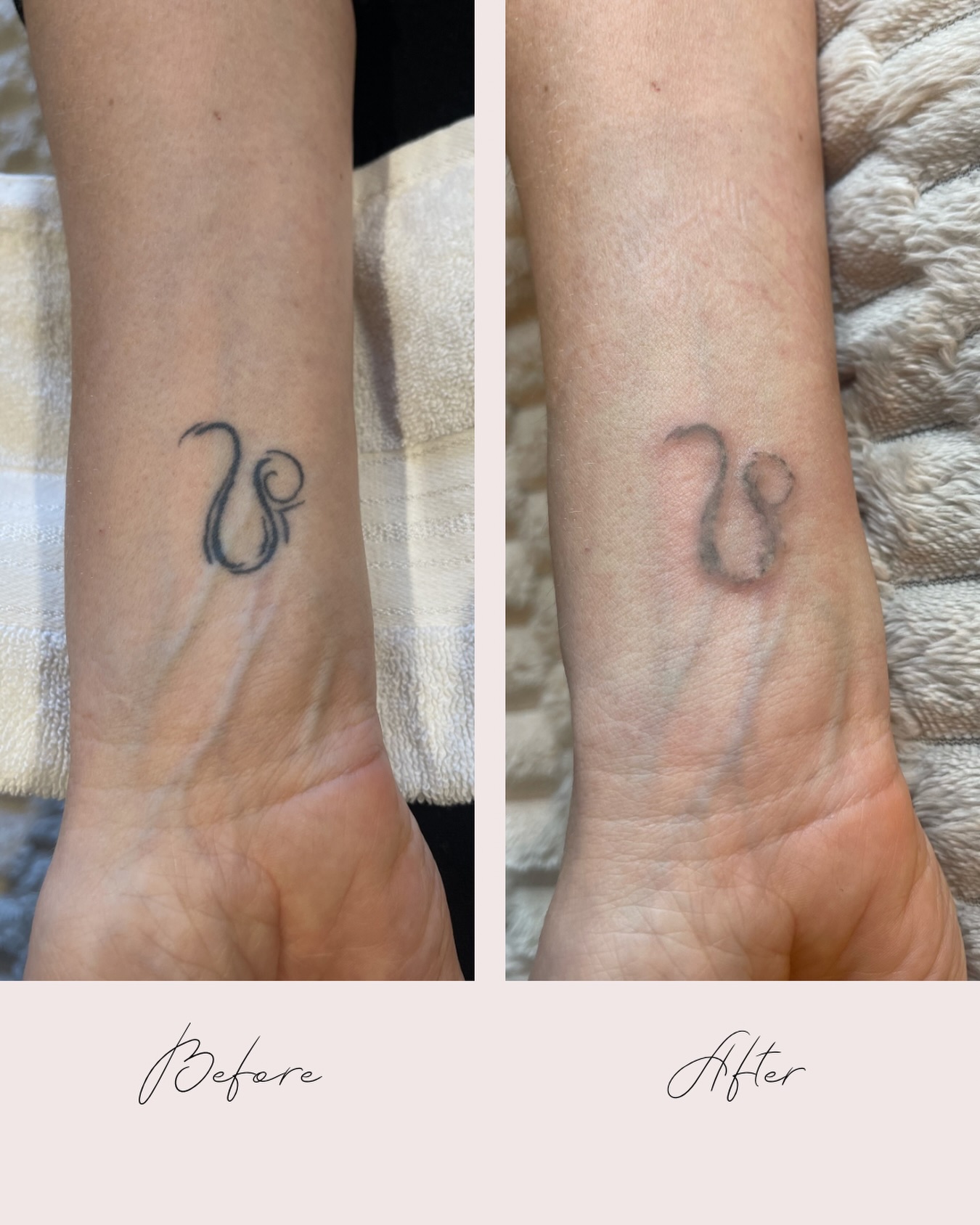 Første behandling er udført ✨
Efter min erfaring forventer jeg, at ca. 4 behandlinger er nok.
Vi følger op om 2 måneder.
#tattoo #skønhedsklinikaarhus #tattooremovalspecialists #aarhus #beauty