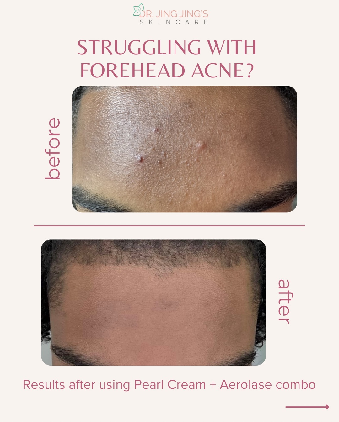 Forehead acne isn’t random 👀
From product buildup to clogged pores and hormones, your skin is reacting to something.
At PFA, we treat it at the source:
✨ Pearl Cream for acne + dark marks
✨ Aerolase to reduce inflammation + bacteria
Clear skin starts with the right plan 🤍
Book your consultation
#ForeheadAcne #AcneTreatment #Aerolase #PearlCream #AtlantaMedSpa