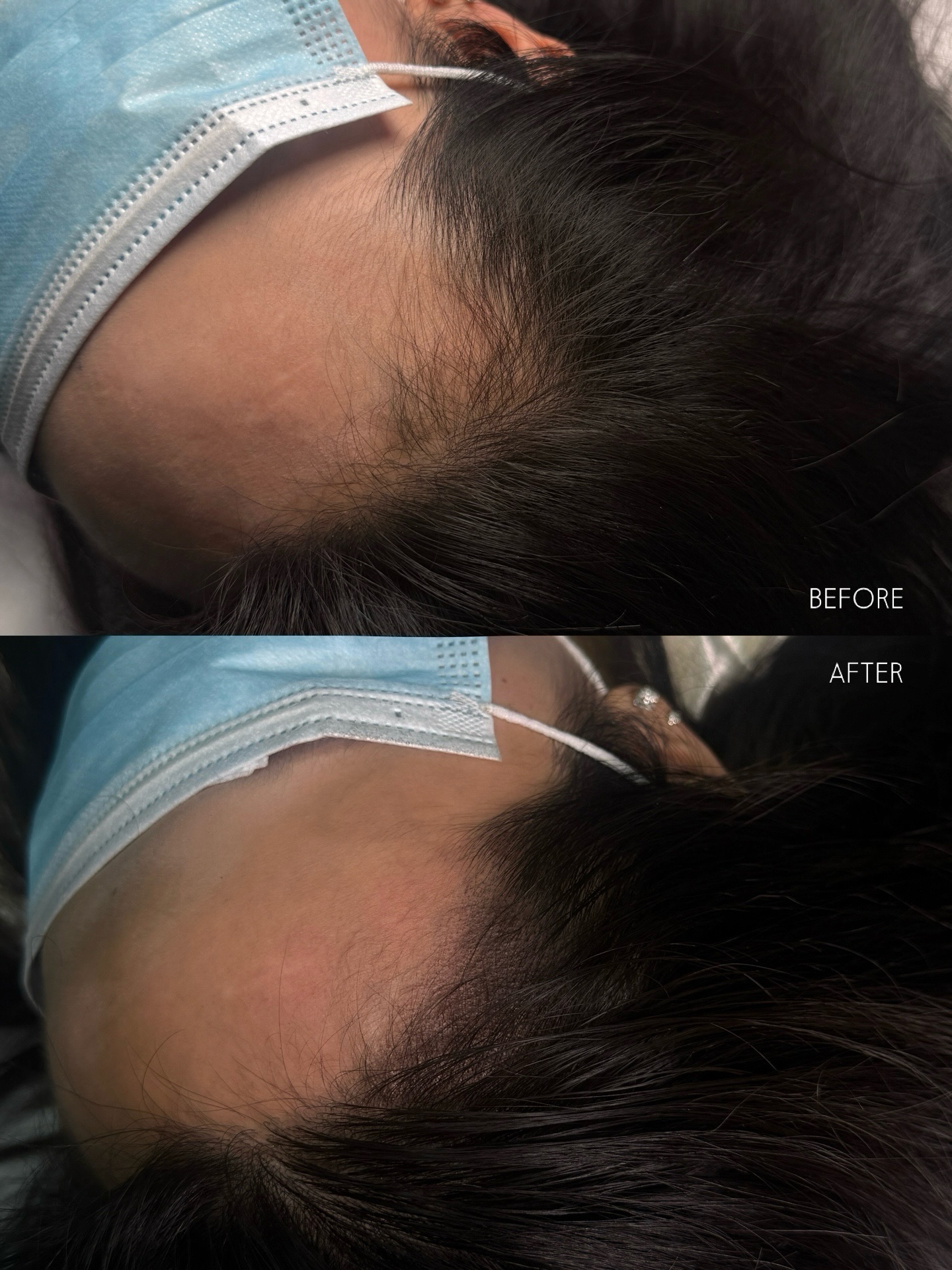 A softer hairline, without looking like anything was done.
Scatter machine allows us to create ultra-fine, natural density that blends perfectly into your existing hair. Minimal discomfort, and ideal for anyone looking to softly fill a sparse hairline🤍
Subtle. Seamless. Effortless💫
#shanghai #스카터 #hairloss #scalpmicropigmentation #smp