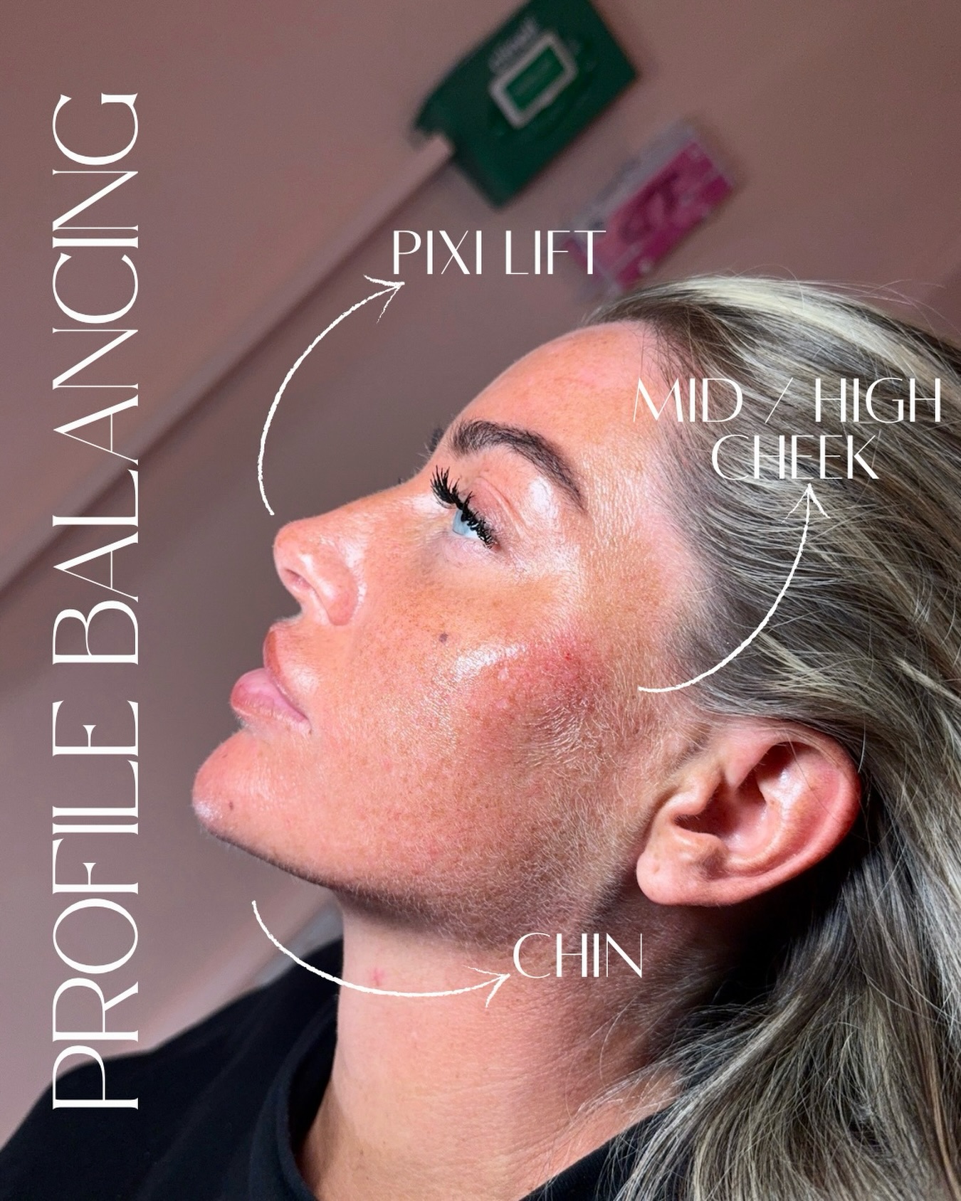 The most stunning results from my profile balancing training day with @aimeecodyaestheticsnewcastle
The softest little tweaks making all the difference💉
Mid/High Cheek Filler
Pixi Lift in the Nose
Chin filler for projection
#profilebalancing #aestheticspractitioner #sunderlandaesthetics