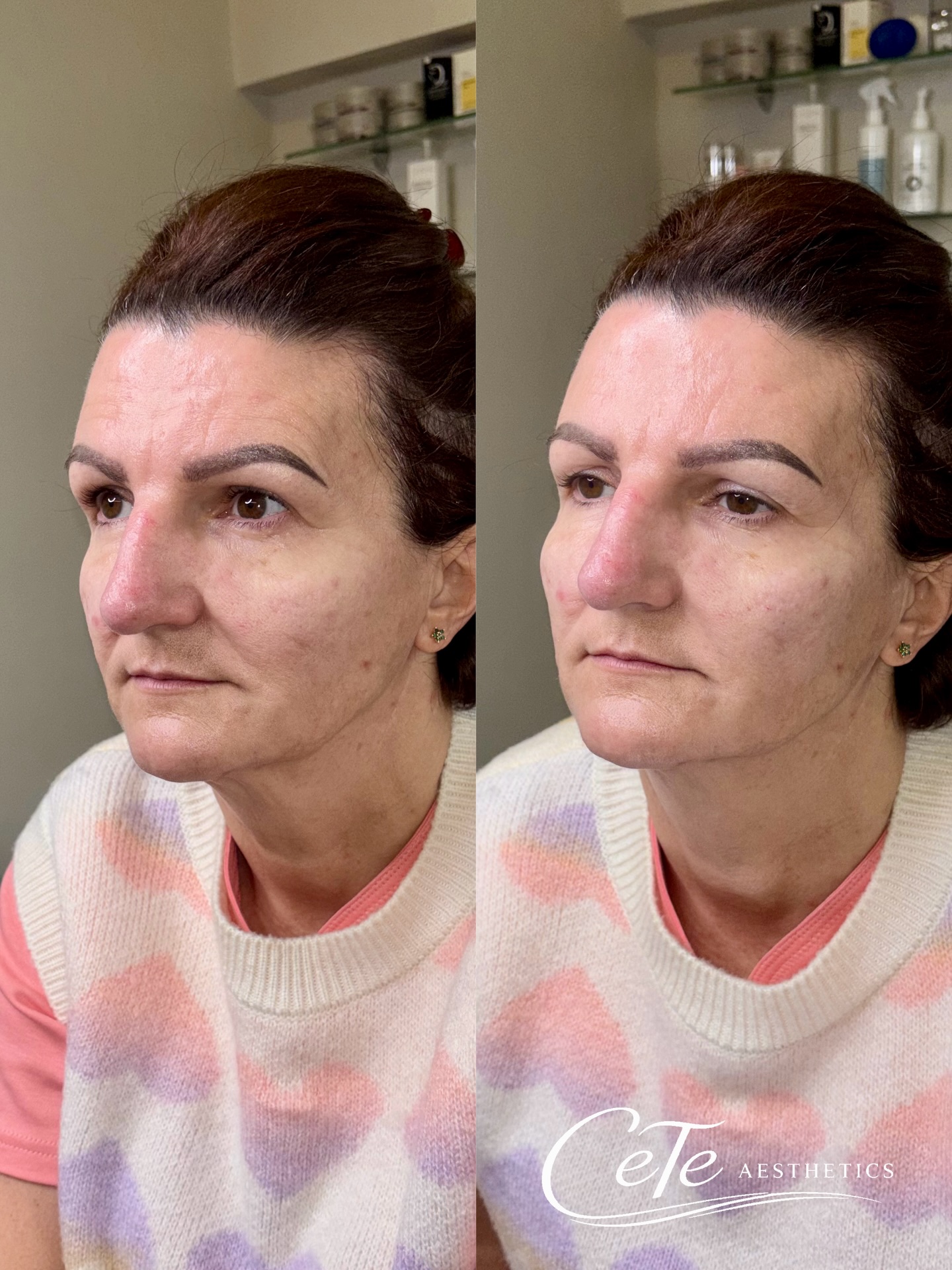 Cheek filler doesn’t just add volume… it can completely transform the lower face ⬇️
This result was achieved using just 1ml of cheek filler.
By restoring structure in the mid-face, we’ve:
• Lifted the lower face
• Softened heaviness around the mouth
• Reduced the appearance of the tear trough area
This is why placement matters more than volume. The right technique can give a subtle, natural lift without overfilling.
Less product. Better strategy. Stronger results.
If your concern is lower face heaviness or under-eye shadows, cheeks might be the answer 💉
——
#cheekenhancement #lowerfacerejuvenation #aestheticslincolnshire #scunthorpebusiness #northlincolnshire