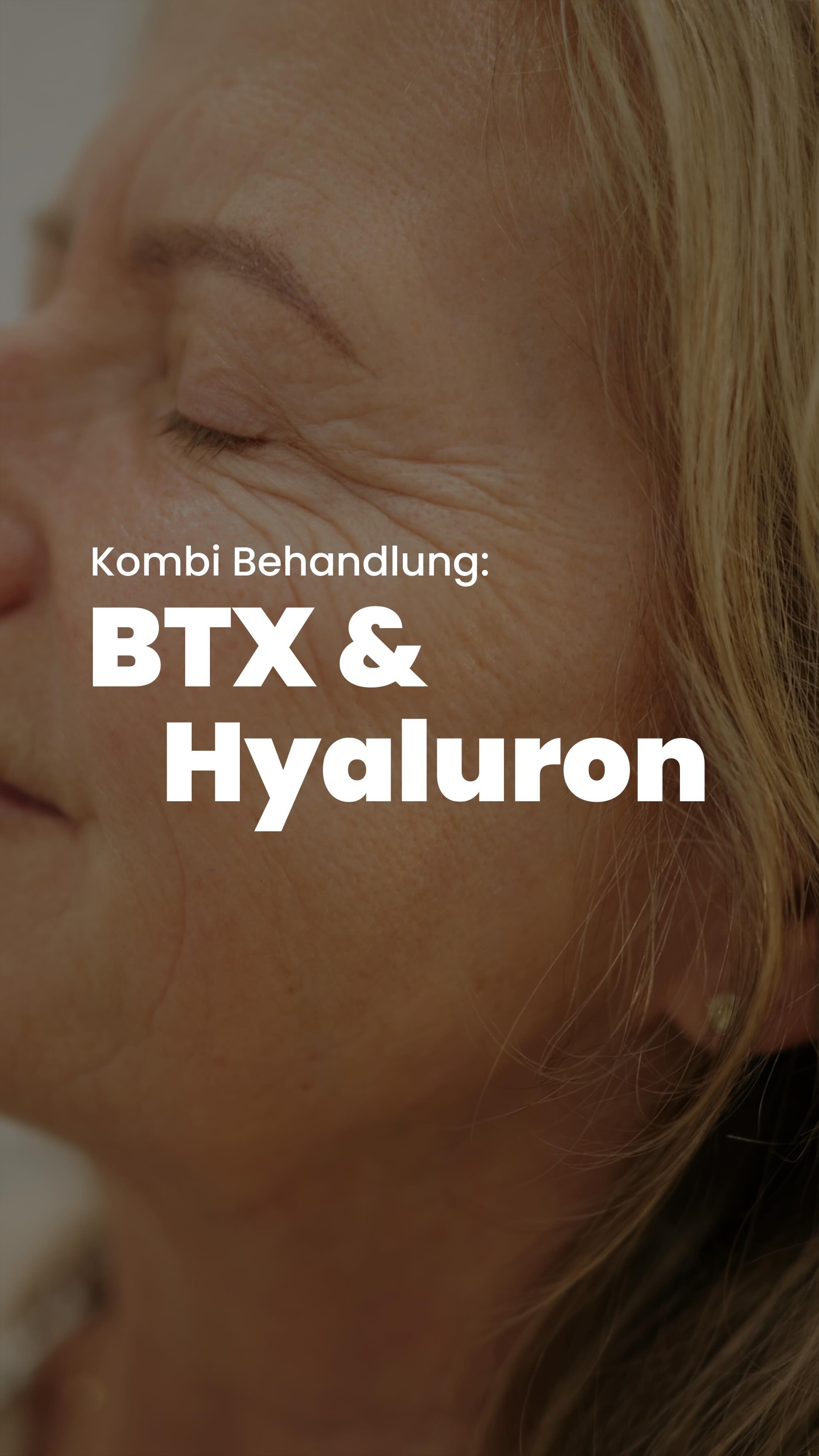 Nach der Hyaluronsäure Behandlung im Gesicht folgt heute der nächste Schritt eine Botulinum Behandlung zur sanften Entspannung der 3 klassischen Zonen im Gesicht ✨
•Stirnfalten
•Zornesfalte
•Krähenfüße
Mir ist besonders wichtig ein natürliches Ergebnis zu erzielen die Mimik soll erhalten bleiben sodass die Patienten nicht eingefroren wirken Gerade bei den Lachfalten darf eine feine natürliche Bewegung bestehen bleiben 🤍
Es ist nie zu spät mit ästhetischen Behandlungen zu beginnen!
Eure Fachärztin Fr. Ludewig
#ludewig #gesichtsbehandlung #btx #stirnfalten #zornesfalte