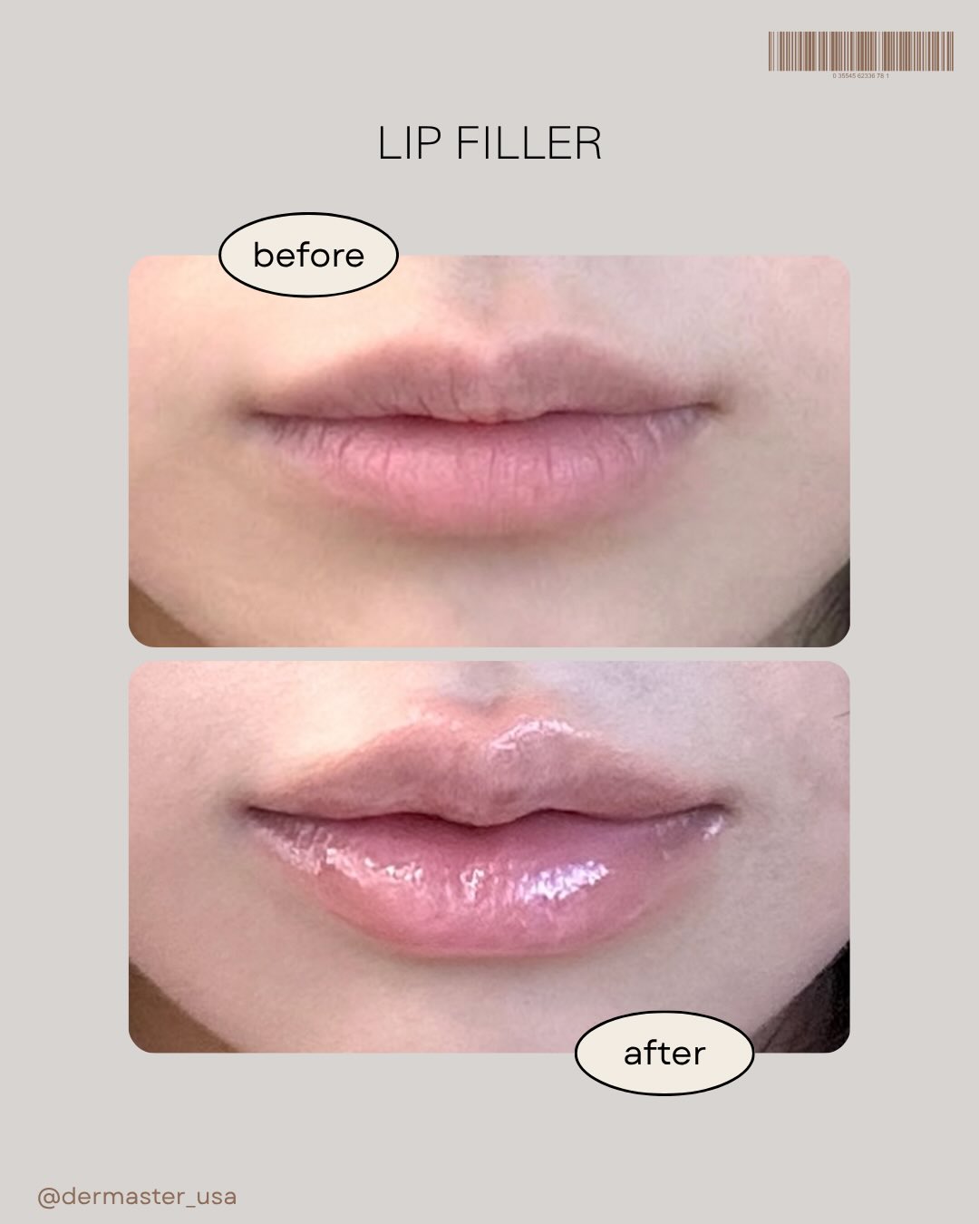 Enhance your natural beauty with lip filler ๐
Subtle volume, defined shape, and hydrated-looking lipsโ
all tailored to complement your facial features.
Whether you want a soft, natural look or a more defined pout,
we customize every treatment just for you.
โจ Instant results
โจ Minimal downtime
โจ Natural-looking enhancement
Book your consultation today and let your lips do the talking ๐ซ
๐ 3000 W Olympic Blvdย #305, Los Angeles
๐ 213-814-8410
#lip #filler #lipfiller #lamedspa #dermaster