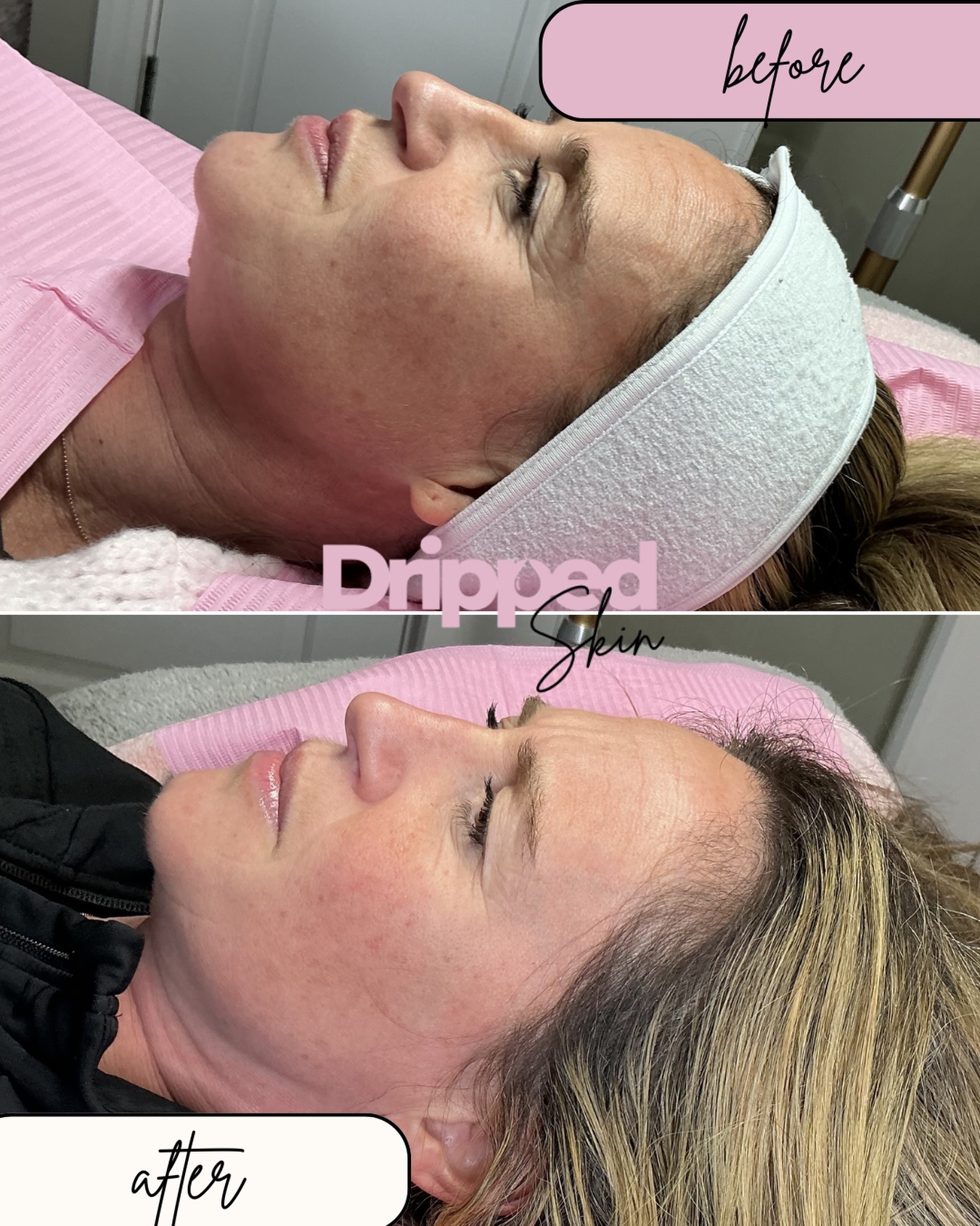 When the treatments start working their magic ✨
One session of mesotherapy with derma 2.0 and 2 sessions of microneedling into her journey 🙌🏽
A course of treatments & consistency for the win always 🤍