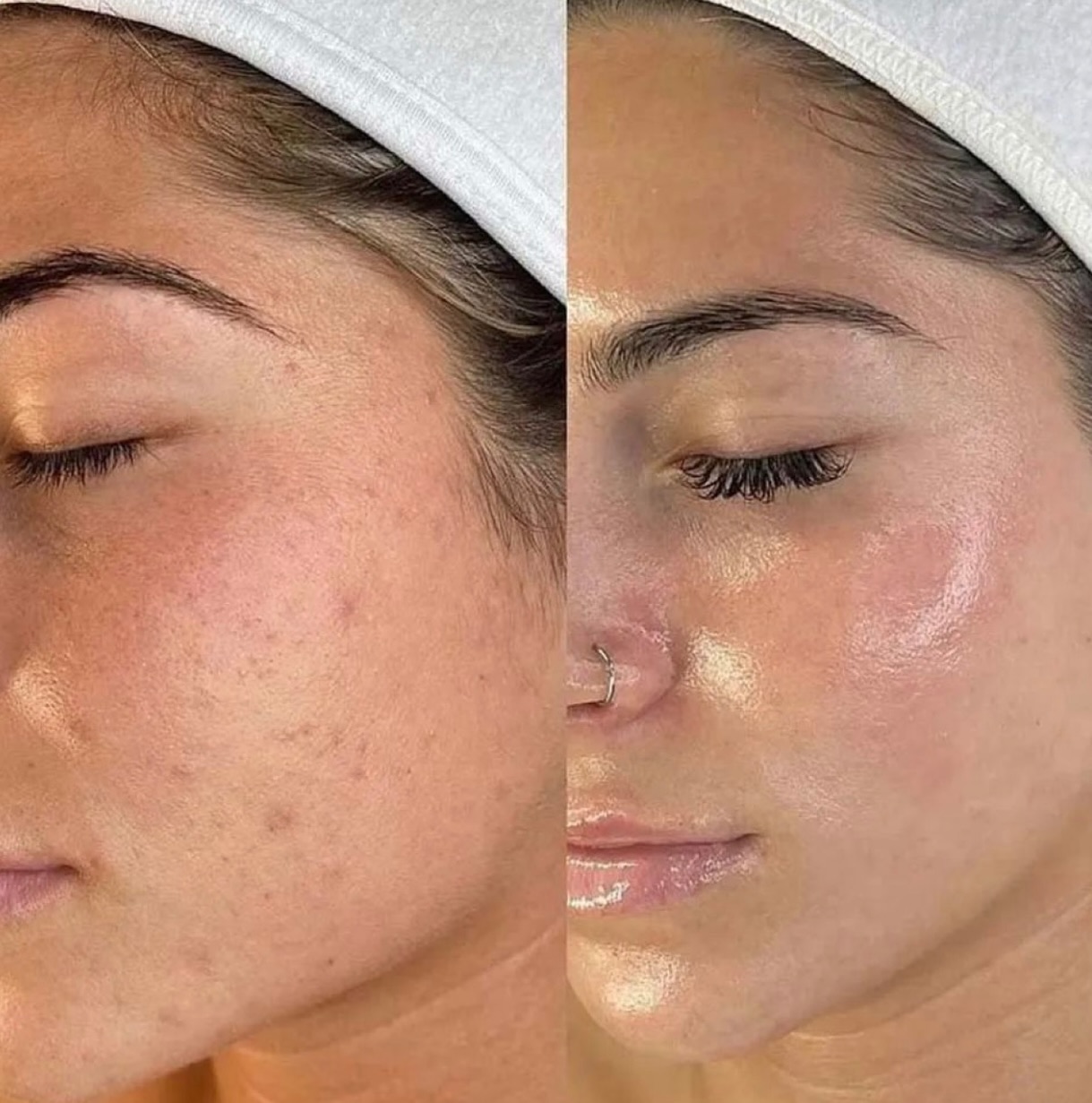 ✨ MICRONEEDLING – 15% OFF ✨
Glow up your skin today! 💆♀️
Firmer, smoother, radiant results.
🎉 Limited offer: 15% OFF
📅 Book now – spots are limited!
📩 DM to schedule your appointment