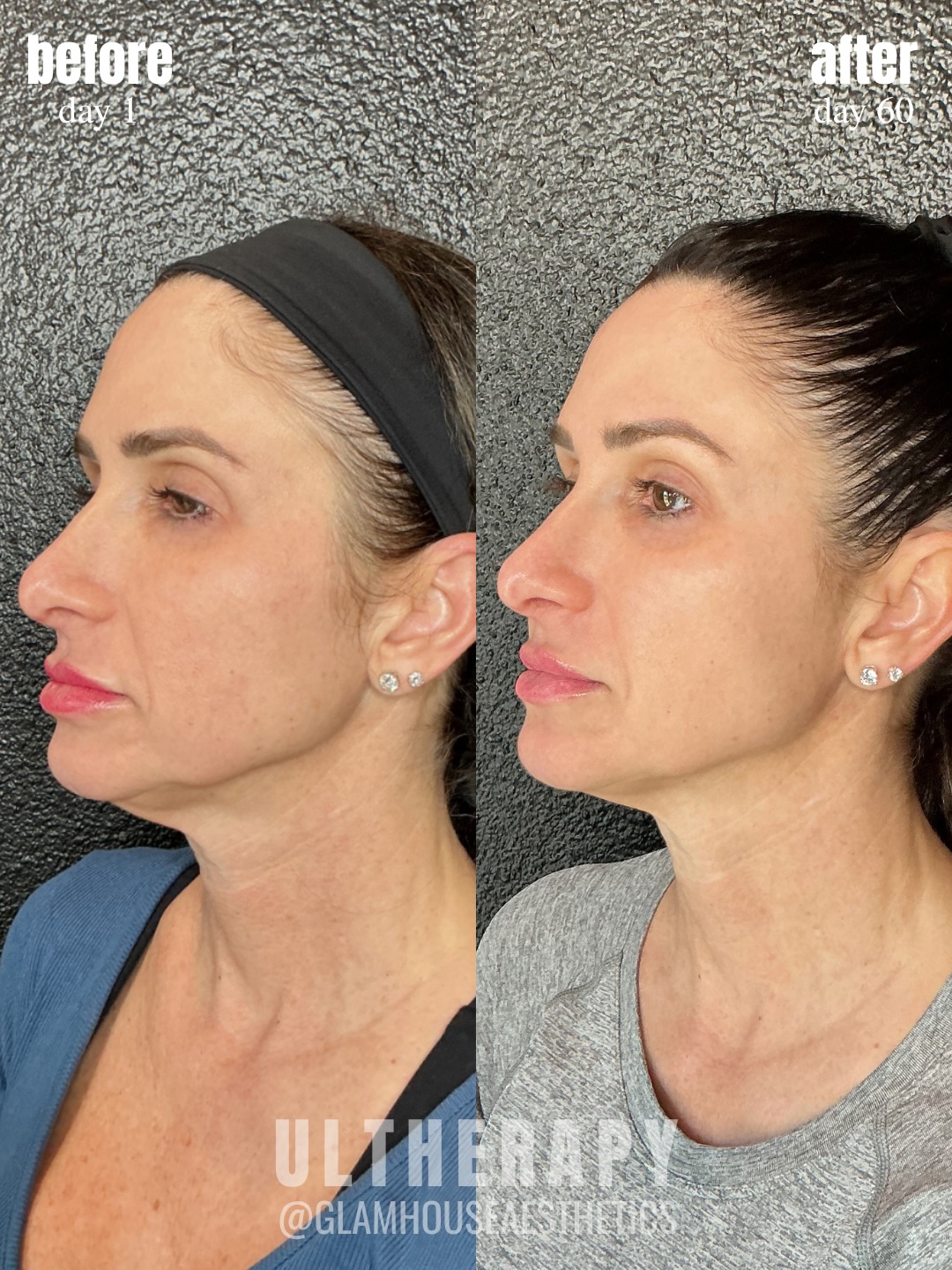 Lifted. Tightened. Refined, without surgery â¨
This is the power of Ultherapy over time đ From day 1 to day 60, you can see a gradual improvement in jawline definition, skin tightening, and overall youthful appearance.
Ultherapy works by using focused ultrasound energy to stimulate your bodyâs natural collagen production, meaning results continue to build weeks after treatment.
If youâve been noticing early signs of laxity in the lower face or neck this is your sign đ¤
#GlamHouseAesthetics #NewBraunfelsMedspa #SanAntonioMedSpa #Ultherapy #CollagenBanking