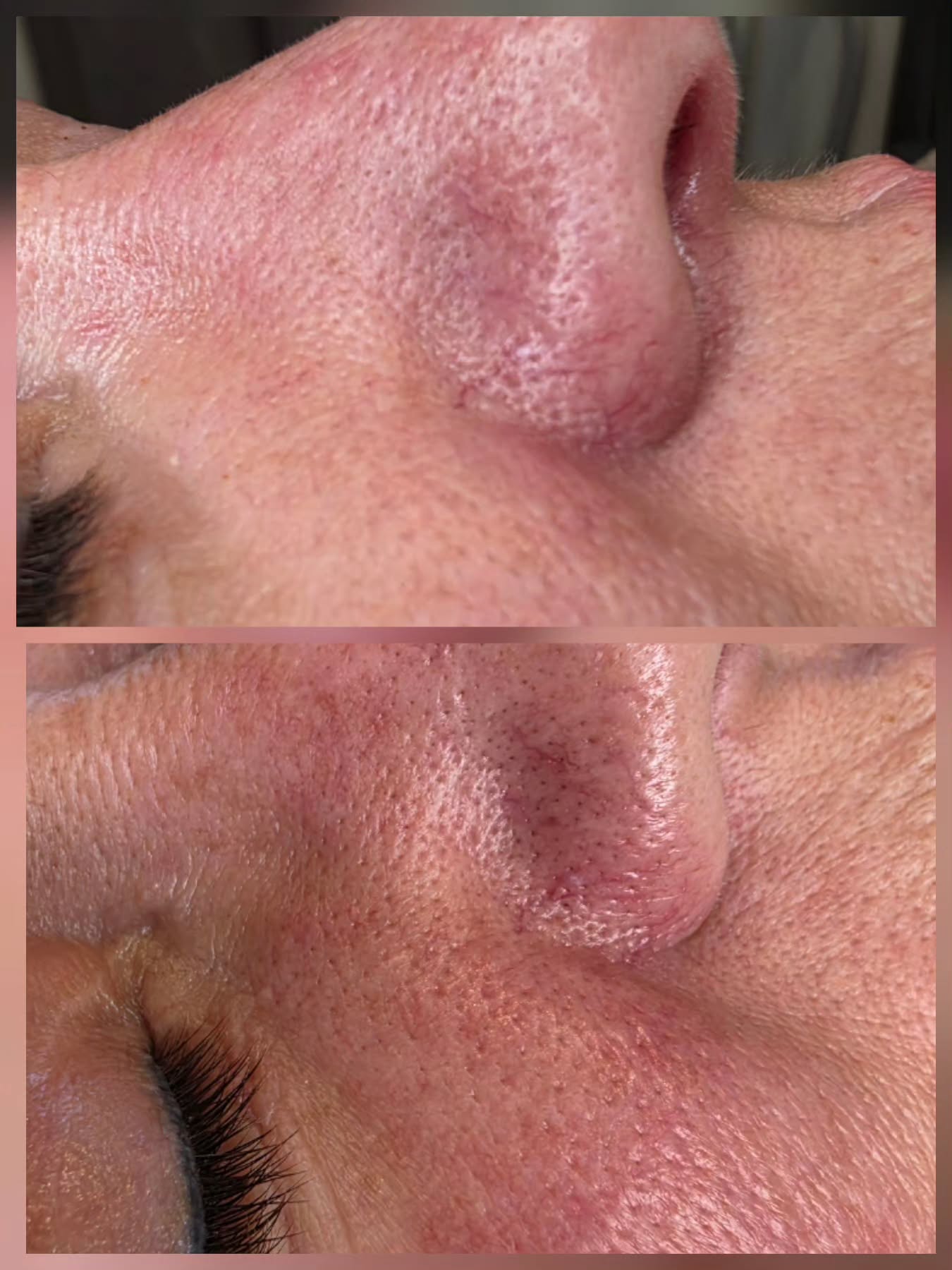 Before and after combining THE MASK everyday and skincare. Rejuvenation mode reduces overall redness in the skin. These results speak for themselves!