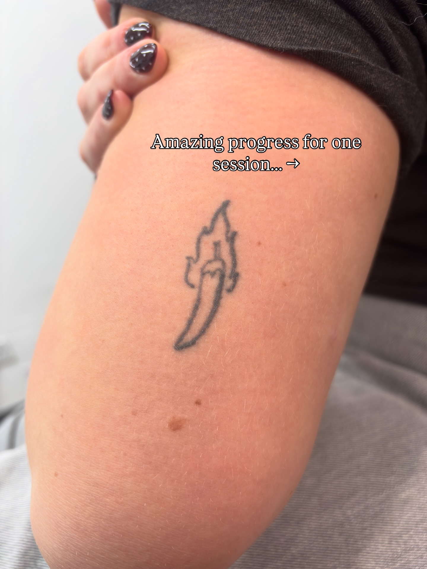 A perfect example of one removal session, healing perfectly.
Book your first session today! We offer free consultations so we can give you an accurate quote.
Call or text 07542902219 for all booking enquiries.
#tattooscotland #lasertattooremoval #removallaser #glasgowtattoo #laserremoval