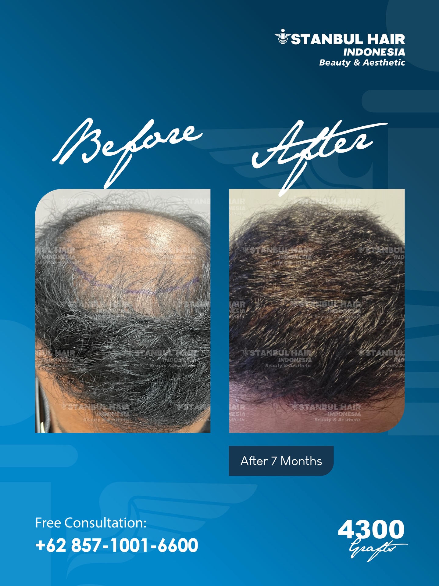 Masih bertanya seperti apa hasil nyatanya?
Seberapa jauh perubahan bisa terjadi hanya dalam beberapa bulan?
Tak perlu banyak kata—biarkan hasil yang berbicara.
Dari area yang dulu menipis, kini kembali terisi dengan lebih padat dan natural.
Bukti nyata yang bisa Anda lihat sendiri, tanpa perlu meyakinkan berlebihan. ✨
Konsultasi GRATIS tersedia untuk Anda yang ingin memulai perubahan.
Mulai langkah pertama Anda hari ini.
—
Still wondering what real results truly look like?
How far can a transformation go in just a matter of months?
No need for excessive words—let the results speak for themselves.
From thinning areas to fuller, more natural density.
A visible proof, captured clearly for you to see. ✨
Free consultation is available for those ready to begin their transformation.
Take your first step today.
#HairTransformation #BeforeAfterProof #HairTransplantIndonesia #NaturalHairResult #ConfidentLook