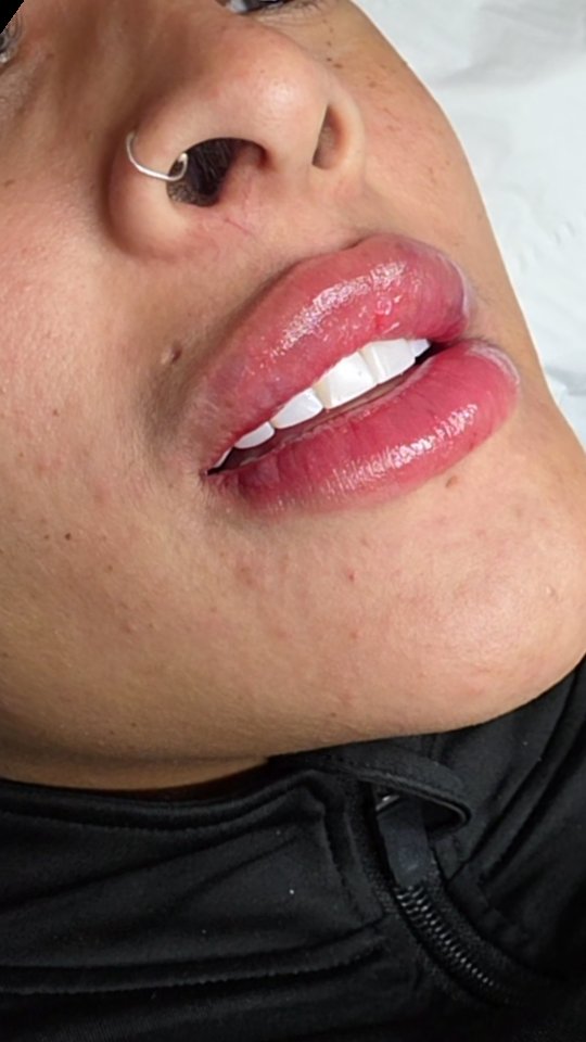 💋 Check out our lovely client’s lip journey 💋
She started with 0.5ml for a subtle enhancement…
Then moved to 1ml of lip boosters for that hydrated, nourished, natural plump ✨
She loved the glow and softness 💖
…but nothing quite compares to the definition and volume of 1ml of filler 😍
Every step is about finding what you love most natural, enhanced, or full glam 💉✨
Thinking about starting your own lip journey? We’ve got you 💋
📩 DM us to book or enquire
📍 hmbsalon.co.uk
#LipJourney #LipFillerUK #NaturalLips #LipEnhancement #AestheticClinic LondonAesthetics HMBSalon