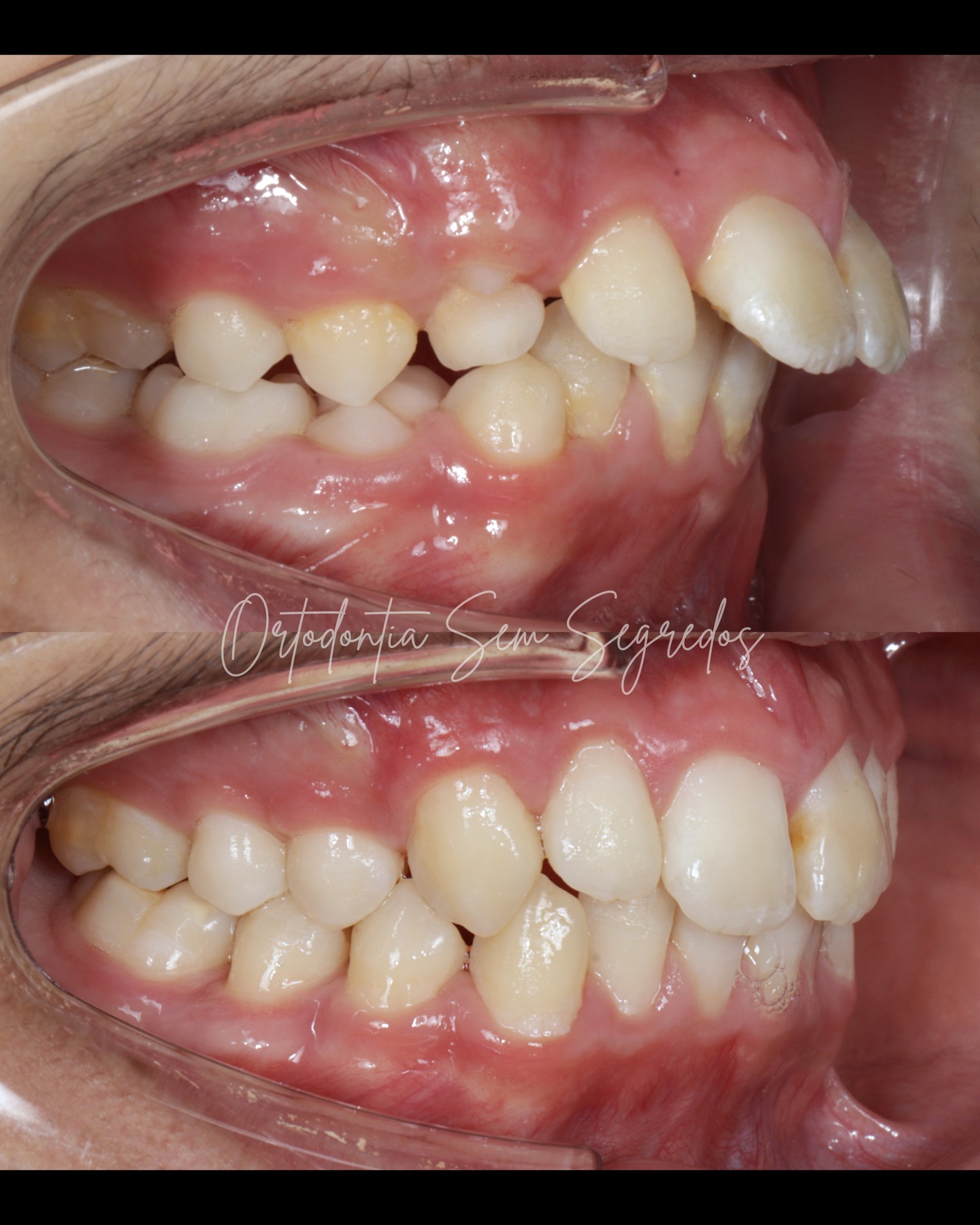 🦷 Classe II tratada no timing certo faz toda a diferença
Neste caso de overjet aumentado e Classe II esquelética e dentária, optámos por um aparelho removível de avanço mandibular, aproveitando o pico de crescimento do paciente.
O resultado?
✔ correção da Classe II
✔ melhoria da relação sagital
✔ controlo dentário com retro-inclinação dos incisivos superiores, através da ativação do arco vestibular
Mais do que o aparelho… foi o timing e o planeamento que fizeram a diferença.
É isto que muda tudo na ortodontia infantil:
saber quando e como intervir.
🎓 Curso de Ortodontia Infantil Sem Segredos
📅 15 a 19 de junho 2026
Aprende a diagnosticar, planear e intervir no momento certo — com segurança, lógica e resultados previsíveis.
👉 Mais informações no link da bio.