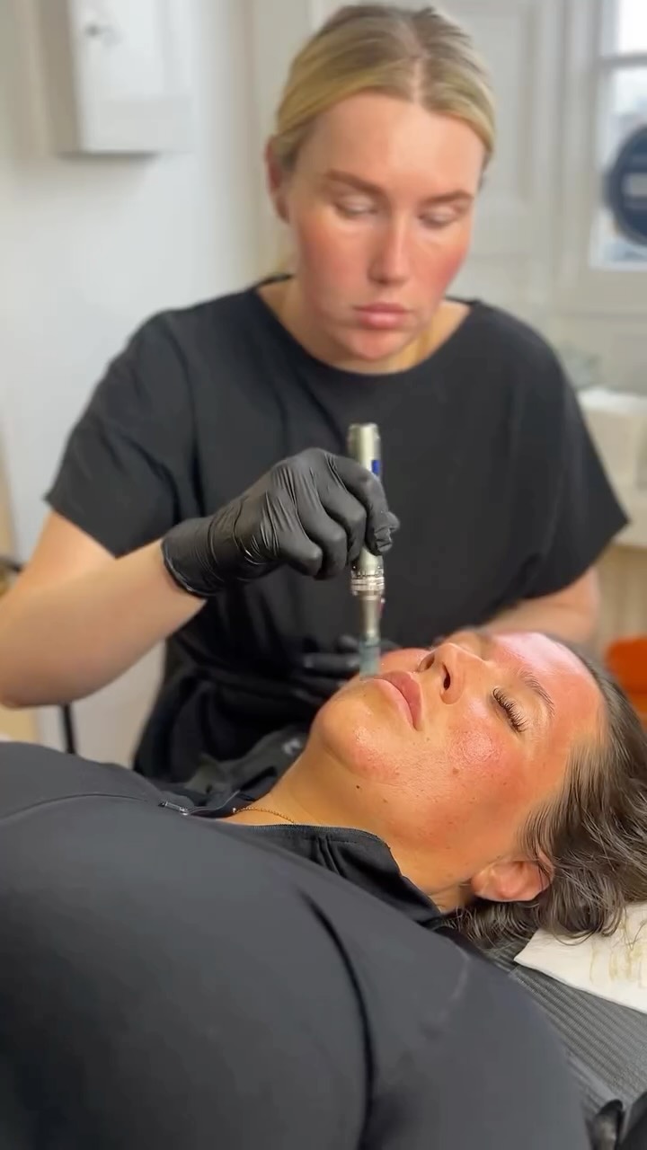 It’s FACIAL SEASON 🧖🏼♀️ 🍃 ✨
No one wants dull / dry skin this summer ☀️ 🏝️
#facial #microneedling #skincare #aesthetics #aestheticssunderland