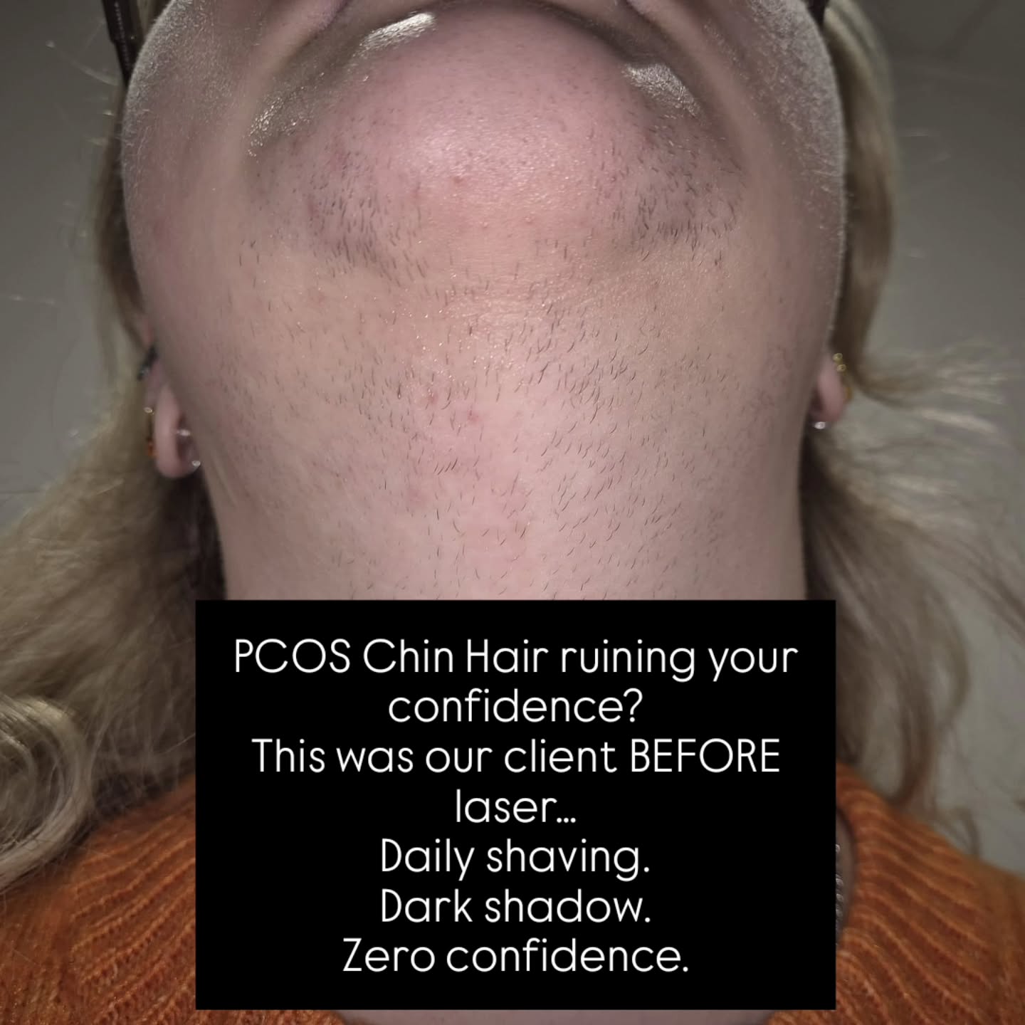 PCOS chin hair can feel relentless…
Shaving every day.
Dark shadow that never disappears.
Ingrown hairs, irritation, and zero confidence.
This is something we see ALL the time in clinic — and you are not alone
This client came to us struggling with hormonal hair growth caused by PCOS.
The hair was thick, fast-growing and difficult to manage.
➡️ After just 6 laser sessions, you can already see a huge difference…
The hair is softer, finer and growing back much slower, with clearer smoother skin.
But let’s be real — PCOS is hormonal.
This isn’t a “one and done” treatment.
More sessions will be needed to keep the hair under control…
BUT laser gives you long-term management instead of daily stress.
No more constant shaving.
No more shadow.
No more feeling self-conscious.
Just results that actually make a difference.
If you’re struggling with PCOS hair growth, this is your sign to start your journey
📍Consultations & patch tests available
Message us today to get a consultation
Limited appointments each week
#pcosawareness #pcos #laserhair #laserhairremoval #laserhairreduction #essexlashtechnician #essexlaserhairremoval #basildonlaserhairremoval #basildonbeautytreatments