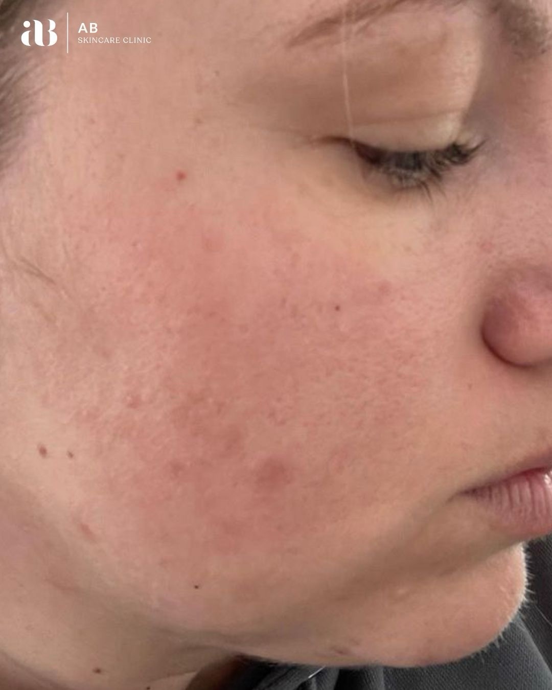This result is a perfect example of why skin health must always come before quick fixes.
When this client first came to the clinic she was experiencing breakout-prone skin alongside a compromised skin barrier. Before we could focus on clearing the acne, our priority was to repair, strengthen and rebalance the skin barrier: the foundation of healthy skin.
Over the course of three months, through a combination of targeted professional treatments, carefully curated home skincare, and tailored lifestyle recommendations, we were able to restore the integrity of the skin. As the barrier strengthened, inflammation reduced and the skin naturally began to clear.
Acne is never an overnight fix, and there is no single โmiracle treatment.โ The skin is a complex, intelligent organ that reflects what is happening internally as much as externally. Factors such as gut health, hormonal balance, environmental stressors, product misuse and lifestyle habits can all contribute to breakouts.
This is why @abskincareclinic we take a true 360ยฐ approach to skin health.
Prioritising long-term skin health over temporary results.
In many cases, the most effective starting point isnโt always an advanced treatment. It may simply begin with lifestyle changes, product adjustments, dietary guidance, or targeted supplementation to support the skin from within.
By respecting the skinโs natural biology and allowing the process to unfold properly, we can create results that are not only visible, but sustainable.
๐ฃ RELEASING SOON is my new 360ยฐ Skin Programme; a comprehensive approach designed to address skin concerns from every angle, both internally and externally.
Initial spaces will be extremely limited.
Send this to a friend who you feel could benefit from our 360ยฐ Skin Programme & DM me SKIN if you are interested in joining the programme/finding out more ๐ซถ