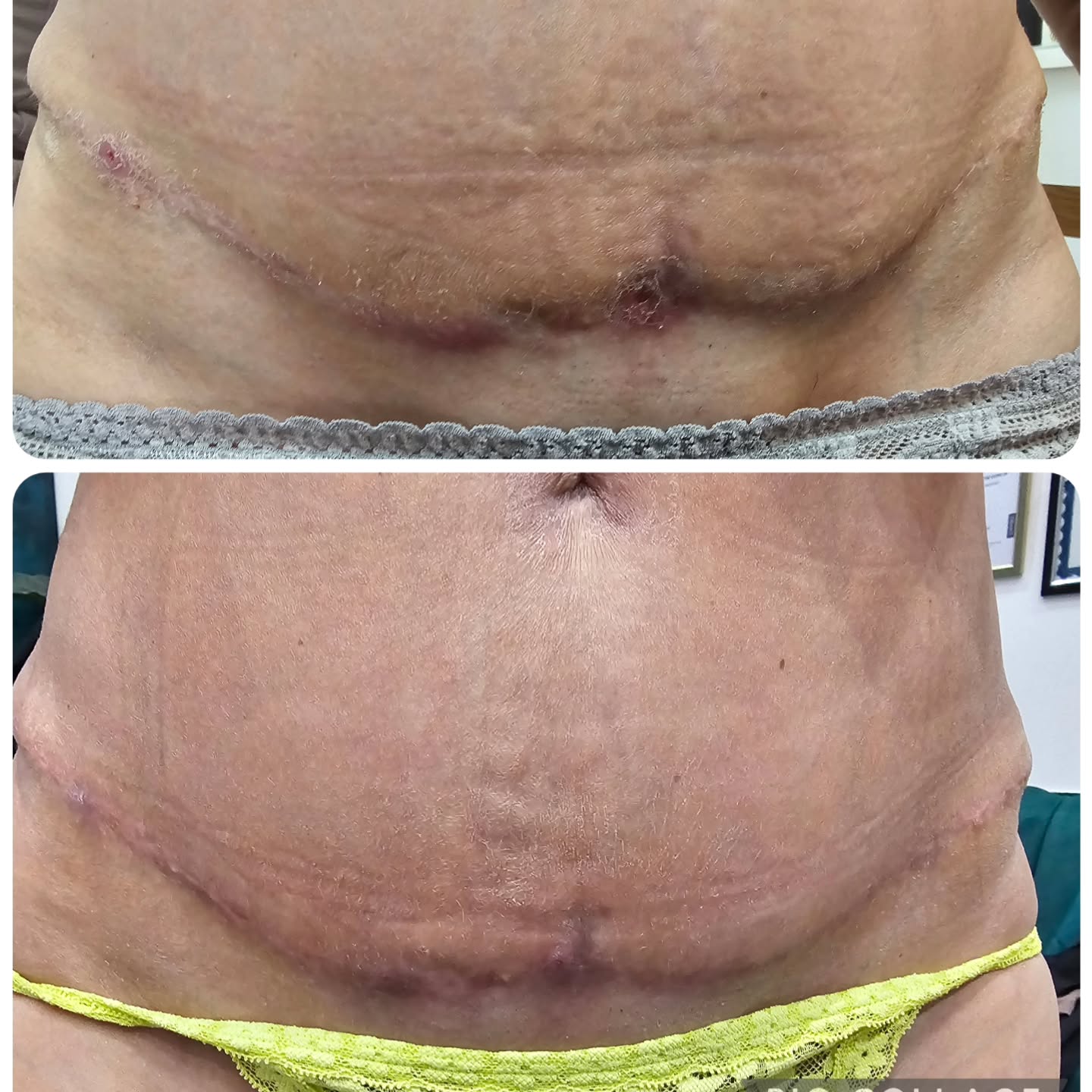 This is a result only after 1 session Post surgery MLD and Physiopod deep osscillation german technology hands on therapy where frequency penetrates deeply through the hands to the client skin and tissue...
Post-lipo recovery isn’t something you should navigate alone ✨
As a manual therapist, my role is to support your body through proper healing after surgery 💆♀️
With post-op lymphatic drainage, I help:
✔️ Reduce swelling & fluid buildup
✔️ Prevent and treat fibrosis (hard lumps)
✔️ Improve your final contour & smoothness
✔️ Ease discomfort and speed up recovery
Every session is tailored to your body and your stage of healing — gentle, intentional, and focused on getting you the best possible results 💖
If you’ve had lipo (or you’re preparing for it), this step is essential, not optional.
Let’s make sure your results heal beautifully ✨
#postlipocare #lymphaticdrainage #manualtherapy #postophealing #bodycontouring aesthetictherapist recoverright