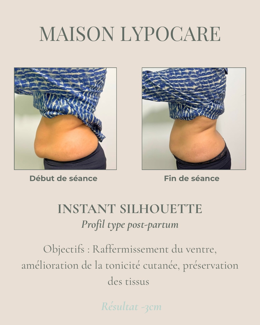 Après un post-partum, le corps ne demande pas toujours « plus », mais surtout « mieux ».
Quand le soin est adapté, qu’il respecte le rythme du corps et qu’il s’inscrit dans une approche douce…
Il suffit parfois de seulement quelques séances pour le relancer, et observer de vraies évolutions.
Des la séance découverte
nous accompagnons chaque femme avec précision et écoute, pour soutenir le corps sans le brusquer.
Parce qu’après une grossesse, tout commence par l’attention que l’on porte à soi 💚