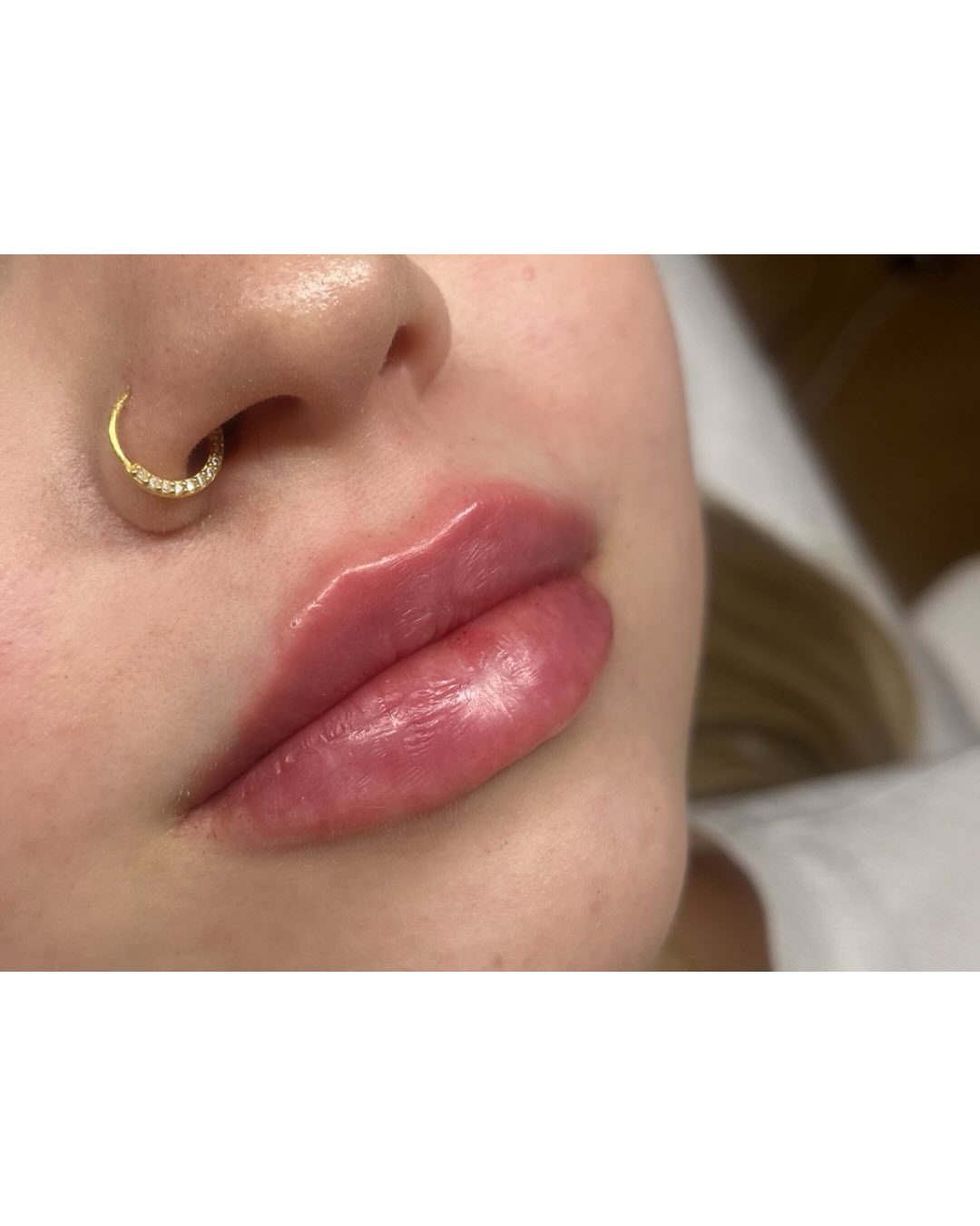 Jemná augmentácia pier kyselinou hyalurónovou 💉
Pri tejto klientke sme sa zamerali na:
▫️ HYDRATÁCIU 💧
▫️ ZVÝRAZNENIE prirodzeného TVARU s rešpektom ku anatomickým pomerom pier 🔬
▫️ jemné zväčšenie objemu bez „overfilled“ efektu a bez migrácie ☝🏼
▫️ ZACHOVANIE prirodzenej DYNAMIKY a MÄKKOSTI pier 🫦
Pery nie sú „spravené“, sú len krajšia verzia samých seba ❤️🔥
Less is more ✨
#lipsaugmentation #aestheticmedicine💉