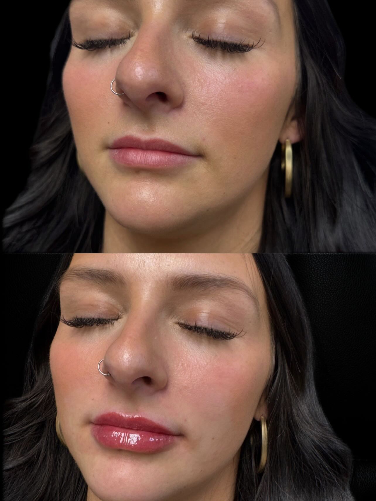 Lip filler is often thought of as adding volume, but the focus is usually on balance and structure.
During treatment, we assess your natural lip shape, proportions, and areas that may benefit from subtle support—such as definition along the border or overall symmetry.
A customized approach helps create results that look soft, proportional, and natural to your features💋