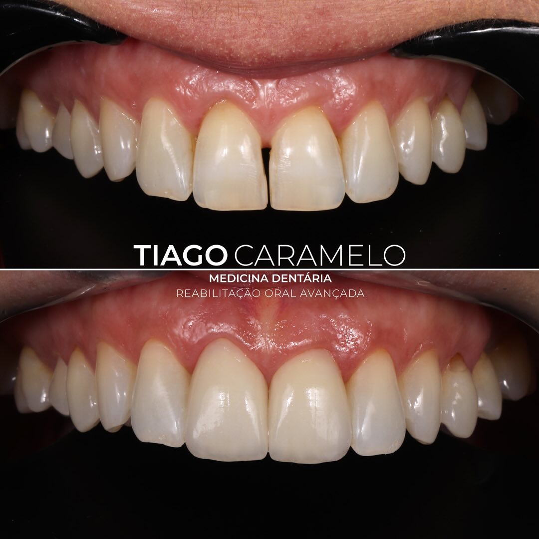 Esta paciente estava descontente com o seu sorriso devido à coloração dos dentes e ao espaço entre os 2 incisivos centrais superiores, o qual restaurou diversas vezes. Deste modo, optei por fazer branqueamento externo em ambulatório e posteriormente 2 facetas feldspáticas, com o intuito de trazer mais harmonia e naturalidade ao sorriso.
Trabalho laboratorial realizado por @anabelasilvacerqueira
—————————————————————————————
This patient was unhappy with her smile due to the coloration of her teeth and the space between her 2 upper central incisors, which she had restored several times. Therefore, I decided to start with external bleaching followed by 2 feldspathic veneers, with the aim of bringing more harmony to her smile.
Laboratory work performed by @anabelasilvacerqueira
#bleachingteeth #veneers #oralrehabilitation #toothprep #adhesivedentistry