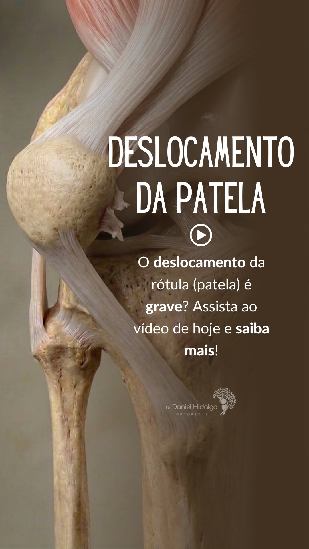 O deslocamento da rótula do joelho, ou patela, é algo grave? 🤔
Essa é uma dúvida muito comum e este vídeo foi gravado justamente para responder uma pergunta feita por um seguidor. A resposta depende de alguns fatores importantes.
Se você já teve essa sensação de “joelho saindo do lugar” ou conhece alguém que passou por isso, esse vídeo pode esclarecer muita coisa.
👉 Assista até o final para entender melhor e encaminhe o vídeo para quem você acha que pode interessar!
Dr. Daniel Hidalgo - Médico Ortopedista
CRM-SP 137.057 | RQE 41.112
Membro da Sociedade Brasileira de Ortopedia e Traumatologia (SBOT)
Membro da Sociedade Brasileira de Cirurgia do Joelho (SBCJ)
Membro da Sociedade Médica Brasileira de Tratamento por Ondas de Choque (SMBTOC)
#ortopedia #joelho #patela #luxacaopatelar #deslocamentopatelar
Você conhece alguém que já teve deslocamento da patela?