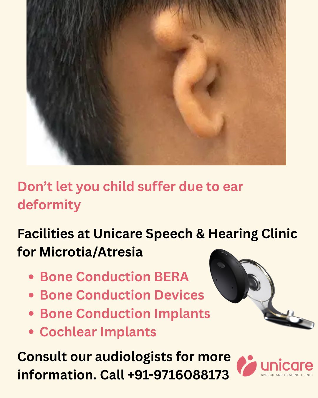 Microtia affects outer ear development and can impact hearing — but modern solutions offer hope. From surgical reconstruction to bone conduction implants, learn how care can restore sound and confidence. Read more: https://wix.to/WWcSwbq #microtia #hearinghealth #audiology #hearingloss