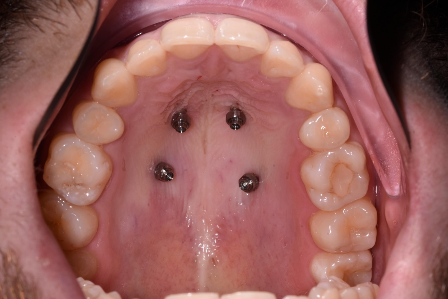 ✨ TADs placement as a first step before MARPE expander ✨
Today we’re preparing for a more advanced orthodontic treatment by placing TADs (Temporary Anchorage Devices) — a key step before fitting a MARPE expander.
🔹 TADs provide stable support
🔹 Allow precise and effective expansion
🔹 Make the treatment more predictable and comfortable
This modern approach helps us achieve better results, especially in adult patients where traditional expansion can be more challenging.
Every step of the journey is carefully planned to give you the best smile possible 🤍
📩 Book your free consultation and start your transformation with us 😍
0 % Finance options available
📍7 Windsor Way, Knutsford WA16 6JB
🌐 www.kclinic.co.uk
📱 07946 219 539
☎️ 01565 653480
#KClinic#Orthodontics#MARPE#TADs #smiletransformations