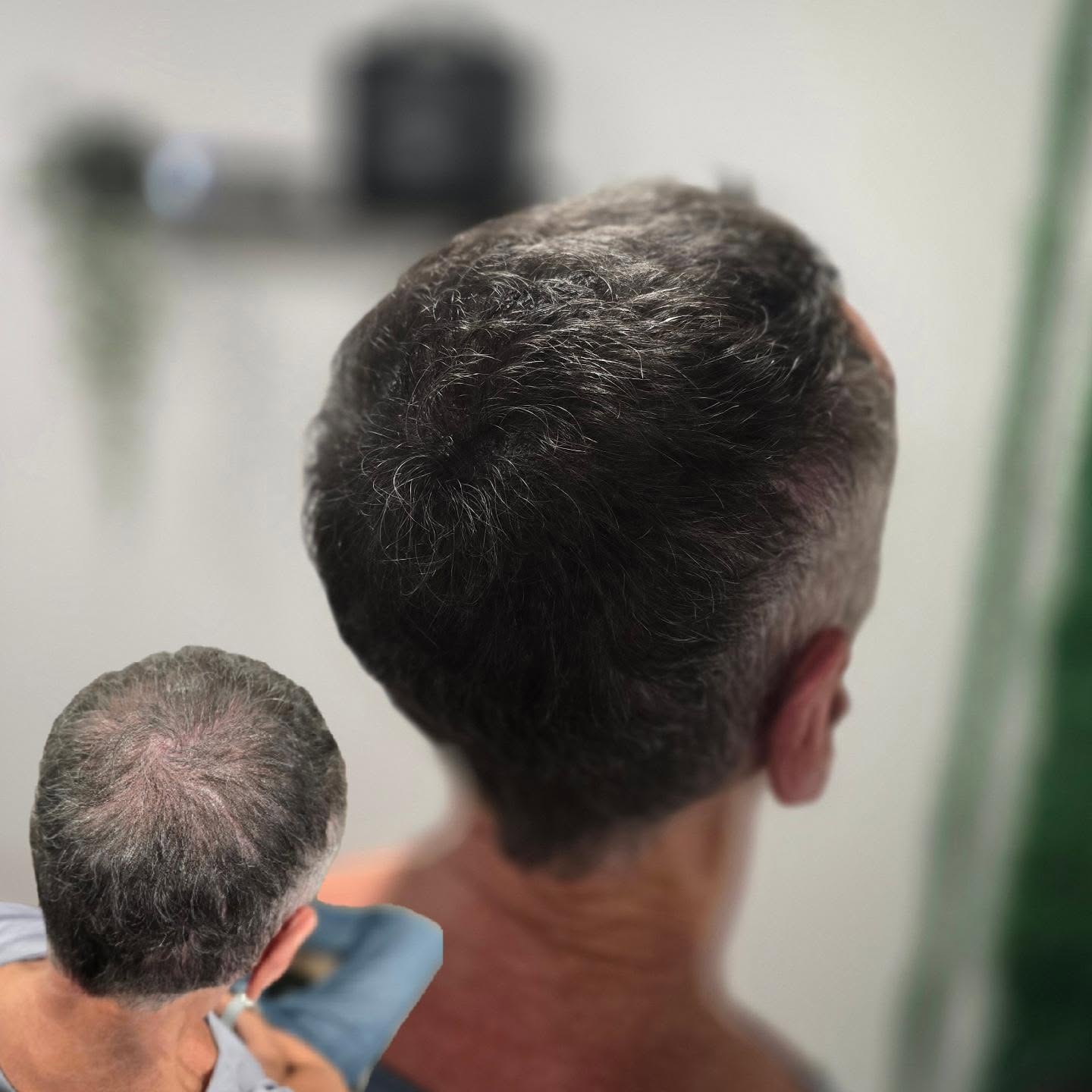 CROWN DENSITY
Nice result from a density treatment to thicken up the crown area!
Scalp Micro-Pigmentation can create the illusion of more follicles, resulting in thicker looking hair
✔️Results from first treatment
✔️Pain often described as 'uncomfortable but not unbearable'
✔️ Natural looking results
✔️Very cost effective against other hair loss solutions
For free consultation, please get in touch!
📍Bury St Edmunds
#scalpmicropigmentation
#hairregrowthtreatment #hairlosssolution
#hairloss #Rosemaryoil #rogaine #minoxidil #prptreatment #prp #hairtransplant #hairtattoo #smp #finasteride